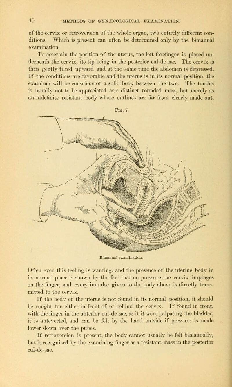 of the cervix or retroversion of the whole organ, two entirely different con- ditions. Which is present can often be determined only by the bimanual examination. To ascertain the position of the uterus, the left forefinger is placed un- derneath the cervix, its tip being in the posterior cul-de-sac. The cervix is then gently tilted upward aud at the same time the abdomen is depressed. If the conditions are favorable and the uterus is in its normal position, the examiner will be conscious of a solid body between the two. The fundus is usually not to be appreciated as a distinct rounded mass, but merely as an indefinite resistant body whose outlines are far from clearly made out. Fig. 7. ^J Bimanual examination. Often even this feeling is wanting, and the presence of the uterine body in its normal place is shown by the fact that on pressure the cervix impinges on the finger, and every impulse given to the body above is directly trans- mitted to the cervix. If the body of the uterus is not found in its normal position, it should be sought for either in front of or behind the cervix. If found in front, with the finger in the anterior cul-de-sac, as if it were palpating the bladder, it is anteverted, and can be felt by the hand outside if pressure is made lower down over the pubes. If retroversion is present, the body cannot usually be felt bimanuallv, but is recognized by the examining finger as a resistant mass in the posterior cul-de-sac.