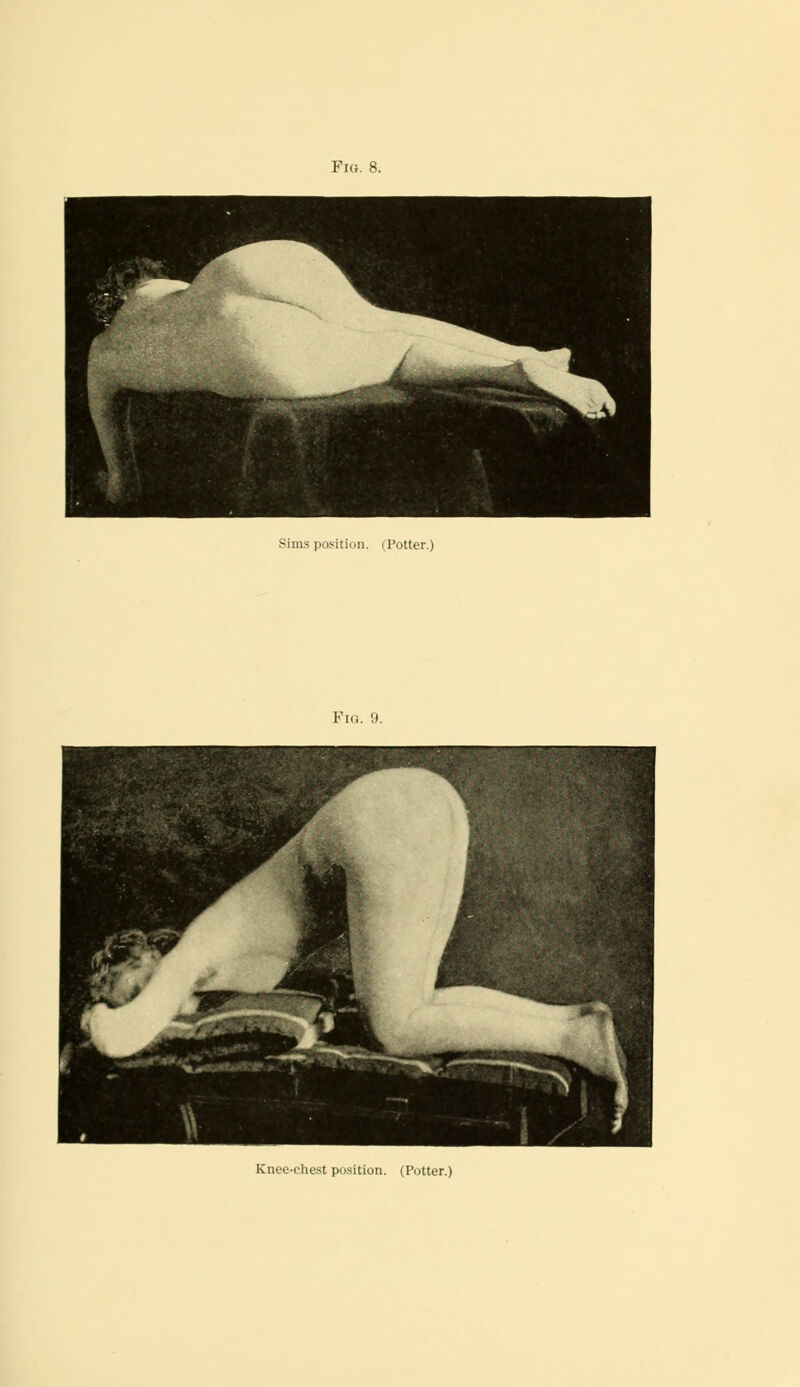 Fro. 8. Sims position, i Totter.) Pia. 9. Knee-chest position. (Potter.)