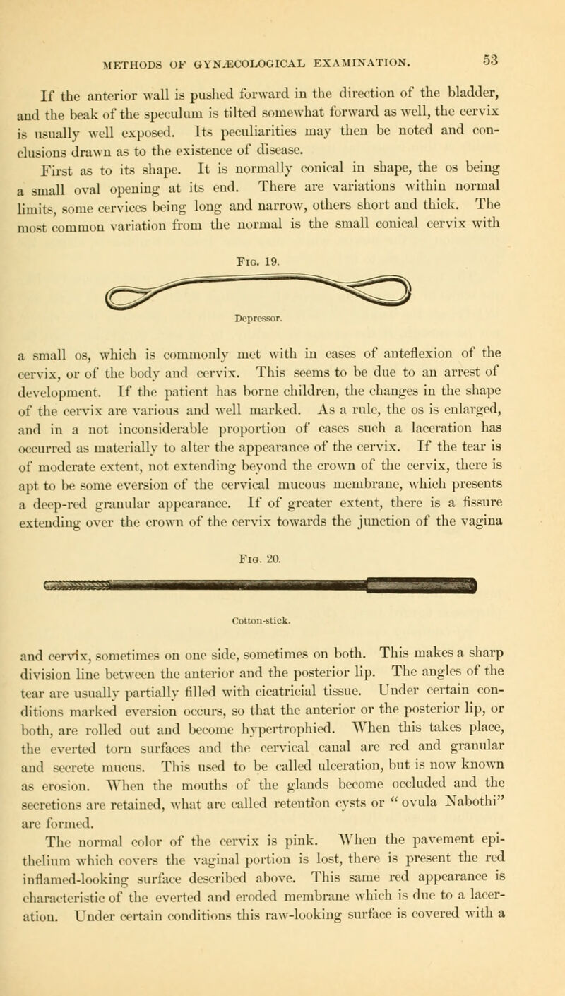 If the anterior wall is pushed forward in the direction of the bladder, and the beak of the speculum is tilted somewhat forward as well, the cervix is usually well exposed. Its peculiarities may then be noted and con- clusions drawn as to the existence of disease. First as to its shape. It is normally conical in shape, the os being a small oval opening at its eud. There are variations within normal limits some cervices being long and narrow, others short and thick. The most common variation from the normal is the small conical cervix with Fig. 19. Depressor. a small os, which is commonly met with in cases of anteflexion of the cervix, or of the body and cervix. This seems to be due to an arrest of development. If the patient has borne children, the changes in the shape of the cervix are various and well marked. As a rule, the os is enlarged, aud in a not inconsiderable proportion of cases such a laceration has occurred as materially to alter the appearance of the cervix. If the tear is of moderate extent, not extending beyond the crown of the cervix, there is apt to he some eversion of the cervical mucous membrane, which presents a deep-red granular appearance. If of greater extent, there is a fissure extending over the crown of the cervix towards the junction of the vagina Fig. 20. Cotton-stick. and cervix, sometimes on one side, sometimes on both. This makes a sharp division line between the anterior and the posterior lip. The angles of the tear are usually partially filled with cicatricial tissue. Under certain con- ditions marked eversion occurs, so that the anterior or the posterior lip, or both, are rolled out and become hypertrophied. When this takes place, the everted torn surfaces and the cervical canal are red and granular and secrete mucus. This used to be called ulceration, but is now known as erosion. When the mouths of the glands become occluded and the secretions air retained, what are called retention cysts or  ovula Nabothi are formed. The normal color of the cervix is pink. When the pavement epi- thelium which covers the vaginal portion is lost, there is present the red inflamed-looking surface described above. This same red appearance is characteristic of the everted and eroded membrane which is due to a lacer- ation. Under certain conditions this raw-looking surface is covered with a