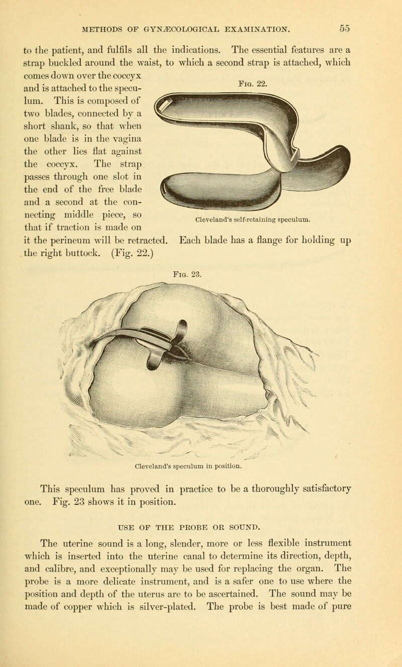 Fig. 22. to the patient, and fulfils all the indications. The essential features are a strap buckled around the waist, to which a second strap is attached, which comes down over the coccyx and is attached to the specu- lum. This is composed of two blades, connected by a short shank, so that when one blade is in the vagina the other lies flat against the coccyx. The strap passes through one slot in the end of the free blade and a second at the con- necting middle piece, so that if traction is made on it the perineum will be retracted the right buttock. (Fig. 22.) Cleveland's self-retaining speculum. Each blade has a flange for holding up Fia. 23. Cleveland's speculum in position. This speculum has proved in practice to be a thoroughly satisfactory one. Fig. 23 shows it in position. USE OF THE PROBE OR SOUND. The uterine sound is a long, slender, more or less flexible instrument which is inserted into the uterine canal to determine its direction, depth, and calibre, and exceptionally may be used for replacing the organ. The probe is a more delicate instrument, and is a safer one to use where the position and depth of the uterus are to be ascertained. The sound may be made of copper which is silver-plated. The probe is best made of pure