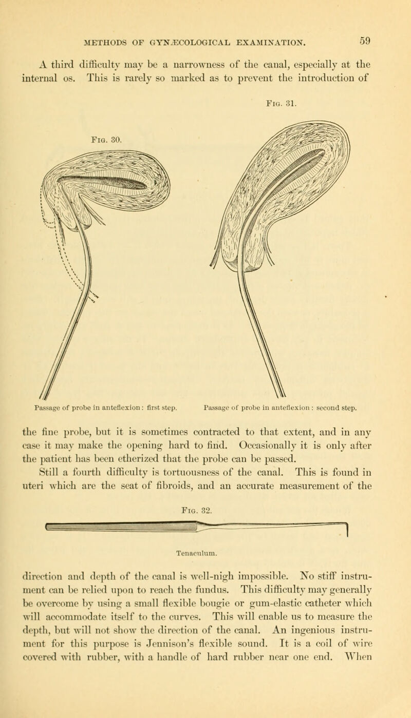 A third difficulty may be a narrowness of the canal, especially at the internal OS. This is rarely so marked as to prevent the introduction of Fig. 30. Passage of probe in anteflexion: first step. Fig. 31. Passage of probe in anteflexion : second step. the fine probe, but it is sometimes contracted to that extent, and in any case it may make the opening hard to find. Occasionally it is only after the patient has been etherized that the probe can be passed. Still a fourth difficulty is tortuousness of the canal. This is found in uteri which are the seat of fibroids, and an accurate measurement of the Fig. 32. —I Tenaculum. direction and depth of the canal is well-nigh impossible. No stiff instru- ment can be relied upon to reach the fundus. This difficulty may generally be overcome by using a small flexible bougie or gum-elastic catheter which will accommodate itself to the curves. This will enable us to measure the depth, but will not show the direction of the canal. An ingenious instru- ment for this purpose is Jeunison's flexible sound. It is a coil of wire covered with rubber, with a handle of hard rubber near one end. When
