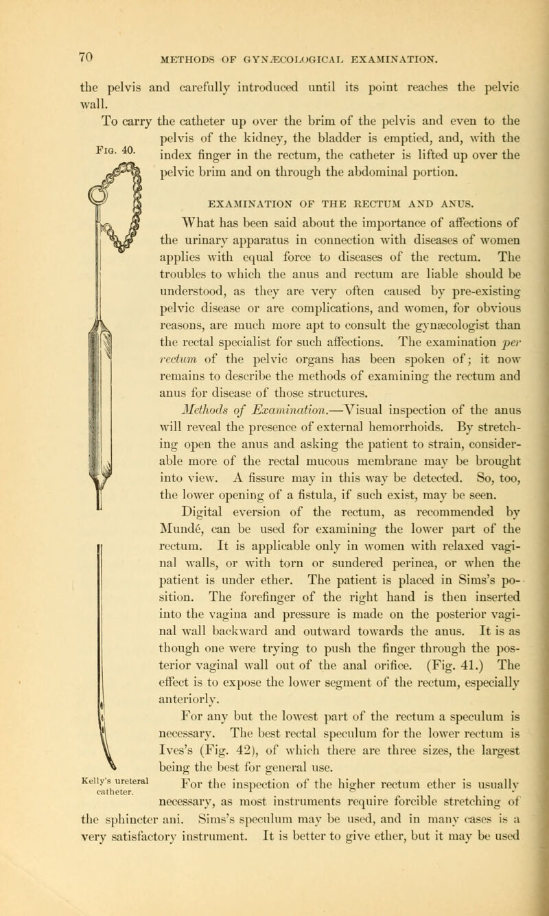 the pelvis and carefully introduced until its point reaches the pelvic wall. To carry the catheter up over the brim of the pelvis and even to the pelvis of the kidney, the bladder is emptied, and, with the index finger in the rectum, the catheter is lifted up over the pelvic brim and on through the abdominal portion. EXAMINATION OF THE RECTUM AND ANUS. What has been said about the importance of affections of the urinary apparatus in connection with diseases of women applies with equal force to diseases of the rectum. The troubles to which the anus and rectum are liable should be understood, as they are very often caused by pre-existing pelvic disease or are complications, and women, for obvious reasons, are much more apt to consult the gynaecologist than the rectal specialist for such affections. The examination per rectum of the pelvic organs has been spoken of; it now remains to describe the methods of examining the rectum and anus for disease of those structures. Methods of Examination.—Visual inspection of the anus will reveal the presence of external hemorrhoids. By stretch- ing open the anus and asking the patient to strain, consider- able more of the rectal mucous membrane may be brought into view. A fissure may in this way be detected. So, too, the lower opening of a fistula, if such exist, may be seen. Digital eversion of the rectum, as recommended by Munde, can be used for examining the lower part of the rectum. It is applicable only in women with relaxed vagi- nal walls, or with torn or sundered perinea, or when the patient is under ether. The patient is placed in Sims's po- sition. The forefinger of the right hand is then inserted into the vagina and pressure is made on the posterior vagi- nal wall backward and outward towards the anus. It is as though one were trying to push the finger through the pos- terior vaginal wall out of the anal orifice. (Fig. 41.) The effect is to expose the lower segment of the rectum, especially anteriorly. For any but the lowest part of the rectum a speculum is necessary. The best rectal speculum for the lower rectum is Ives's (Fig. 42), of which there are three sizes, the largest being the best for general use. Keiiys ureteral Yov the inspection of the higher rectum ether is usually catheter. l ° necessary, as most instruments require forcible stretching of the sphincter ani. Sims's speculum may be used, and in many cast's is a very satisfactory instrument. It is better to give ether, but it may be used