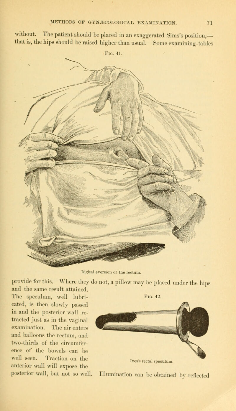 without. The patient should be placed in an exaggerated Sinis's position,— that is, the hips should be raised higher than usual. Some exainininir-tables Fig. 41. Digital eversion of the rectum. provide for this. Where they do not, a pillow may be placed under the hips and the same result attained. The speculum, well lubri- Fig. 42. rated, is then slowly passed in and the posterior wall re- tracted just as in the vaginal examination. The air enters and balloons the rectum, and two-thirds of the circumfer- ence of the bowels can be well seen. Traction on the T„DC.. , , Ives s rectal speculum. anterior wall will expose the posterior wall, but not so well. Illumination can he obtained by reflected