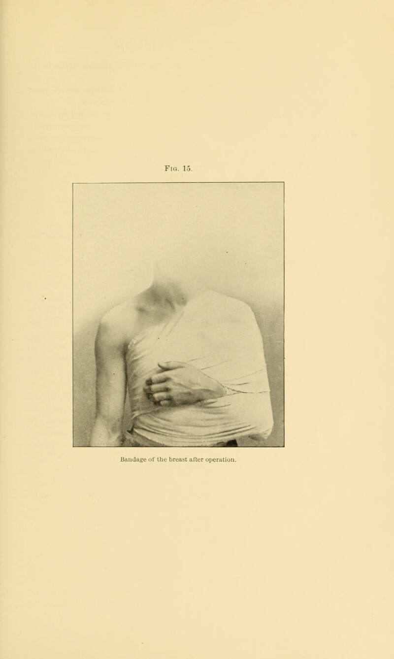 Pig. 15 Bandage of the breast after operation.