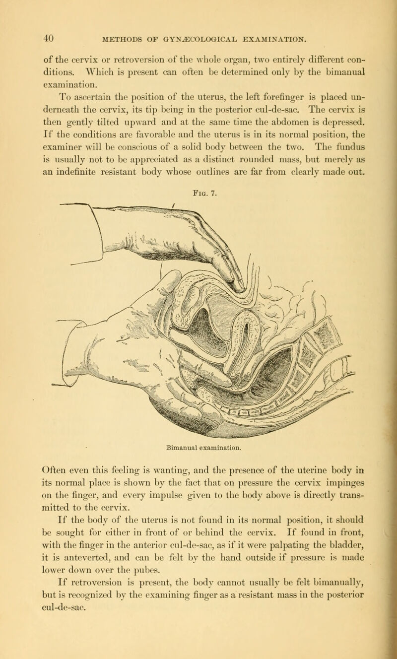of the cervix or retroversion of the whole organ, two entirely different con- ditions. Which is present can often be determined only by the bimanual examination. To ascertain the position of the uterus, the left forefinger is placed un- derneath the cervix, its tip being in the posterior cul-de-sac. The cervix is then gently tilted upward and at the same time the abdomen is depressed. If the conditions are favorable and the uterus is in its normal position, the examiner will be conscious of a solid body between the two. The fundus is usually not to be appreciated as a distinct rounded mass, but merely as an indefinite resistant body whose outlines are far from clearly made out. Fig. 7. Bimanual examination. Often even this feeling is wanting, and the presence of the uterine body in its normal place is shown by the fact that on pressure the cervix impinges on the finger, and every impulse given to the body above is directly trans- mitted to the cervix. If the body of the uterus is not found in its normal position, it should be sought for either in front of or behind the cervix. If found in front, with the finger in the anterior cul-de-sac, as if it were palpating the bladder, it is antevertcd, and can be felt by the hand outside if pressure is made lower down over the pubes. If retroversion is present, the body cannot usually be felt bimanually, but is recognized by the examining finger as a resistant mass in the posterior cul-de-sac.