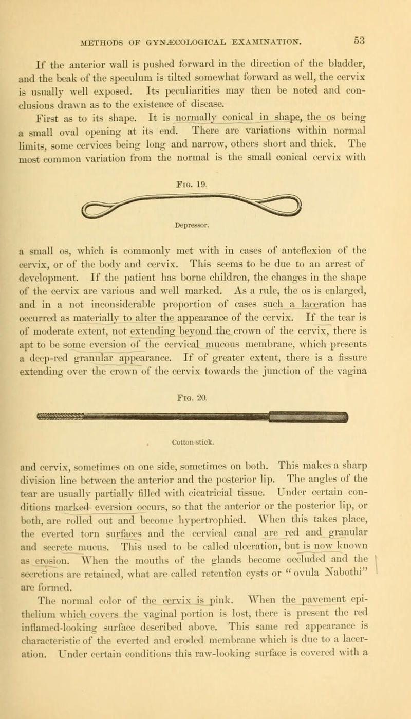 If the anterior wall is pushed forward in the direction of the bladder, and the beak of the speculum is tilted somewhat forward as well, the cervix is usually well exposed. Its peculiarities may then be noted and con- elusions drawn as to the existence of disease. First as to its shape. It is normally conical in shape, the os being a small oval opening at its end. There are variations within normal limits, some cervices being long and narrow, others short and thick. The most common variation from the normal is the small conical cervix with Fig. 19 Depressor. a small os, which is commonly met with in cases of anteflexion of the cervix, or of the body and cervix. This seems to be due to an arrest of development. If the patient has borne children, the changes in the shape of the cervix are various and well marked. As a rule, the os is enlarged, and in a not inconsiderable proportion of cases such a laceration has occurred as materially to alter the appearance of the cervix. If the tear is of moderate extent, not extending beyond the crown of the cervix, there is apt to he some eversion of the cervical mucous membrane, which presents a deep-red granular appearance. If of greater extent, there is a fissure extending over the crown of the cervix towards the junction of the vagina Fig. 20. Cotton-stick. and cervix, sometimes on one side, sometimes on both. This makes a sharp division line between the anterior and the posterior lip. The angles of the tear are usually partially rilled with cicatricial tissue. Under certain con- ditions marked eversion occurs, so that the anterior or the posterior lip, or both, are rolled out and become hypertrophied. When this takes place, the everted torn surfaces and the cervical canal are red and granular ami secrete mucus. This \\>i'i\ to he called ulceration, but is now known as erosion. When the mouths of the glands become occluded and the secretions are retained, what are called retention cysts or  ovula Xabothi are formed. The normal color of the cervix is pink. When the pavement epi- thelium which covers the vaginal portion is lost, there is present the red inflamed-looking surface described above. This same red appearance is characteristic of the everted and eroded membrane which is due to a lacer- ation. Under certain conditions this raw-looking surface is covered with a