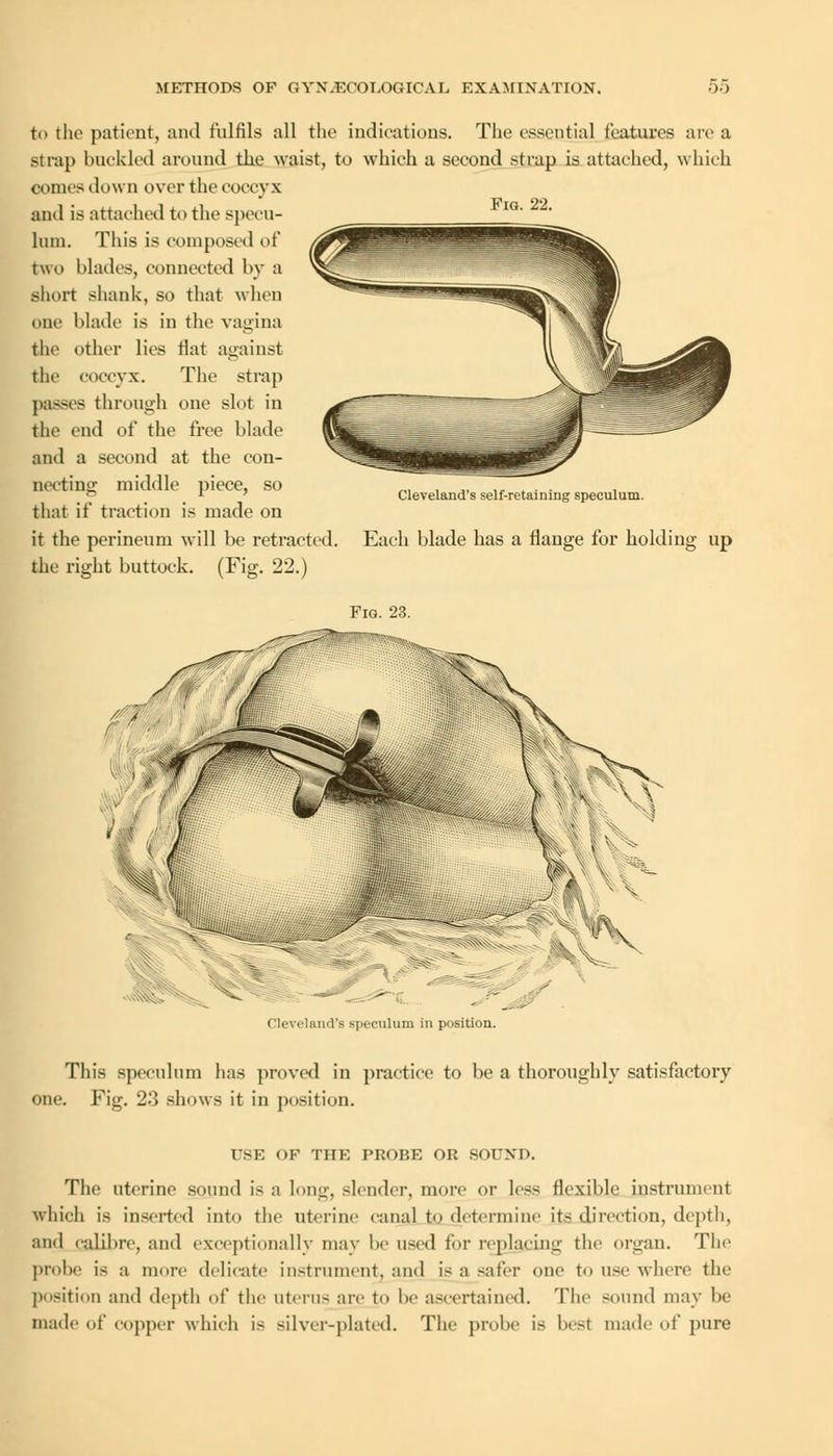 Fig. 22. to the patient, and fulfils all the indications. The essential features are a strap buckled around the waist, to which a second strap is attached, which comes down over the coccyx and is attached to the specu- lum. This is composed of two blades, connected by a short shank, so that when one blade is in the vagina the other lies flat against the coccyx. The strap passes through one slot in the end of the free blade and a second at the con- necting middle piece, so that if traction is made on it the perineum will be retracted. the right buttock. (Fig. 22.) Cleveland's self-retaining speculum. Each blade has a flange for holding up Fig. 23. Cleveland's speculum in position. This speculum has proved in practice to be a thoroughly satisfactory one. Fig. 23 shows it in position. USE OP THE PROBE OR SOUND. The uterine sound is a long, slender, more or less flexible instrument which is inserted into the uterine canal to determine its direction, depth, and calibre, and exceptionally may be used for replacing the organ. The probe is a more delicate instrument, and is a safer one to use where the position and depth of the uterus are to be ascertained. The sound may be made of copper which is silver-plated. The probe is besl made of pure