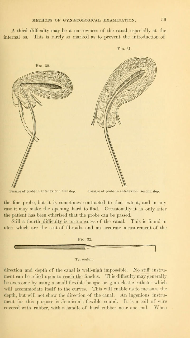 A third difficulty may be a narrowness of the canal, especially at the internal 08. This is rarely so marked as to prevent the introduction of Fig. 30. Passage of probe in anteflexion: first step. Fig. 81. Passage of probe in anteflexion : second step. the fine probe, but it is sometimes contracted to that extent, and in any case it may make the opening hard to find. Occasionally it is only after the patient has been etherized that the probe can be passed. Still a fourth difficulty is tortuousness of the canal. This is found in uteri which are the seat of fibroids, and an accurate measurement of the Pig. 32. ~l Tenaculum. direction and depth of the canal is well-nigh impossible. No stiff instru- ment ran be nlicd upon to reach the fundus. This difficulty may generally be overcome by using a small flexible bougie or gum-elastic catheter which will accommodate itself to the curves. This will enable us to measure the depth, but will not show the direction of the canal. An ingenious instru- ment for this purpose is Jennison's flexible sound. Tt is a coil of wire covered with rubber, with a handle of hard rubber near one end. Y\ hen