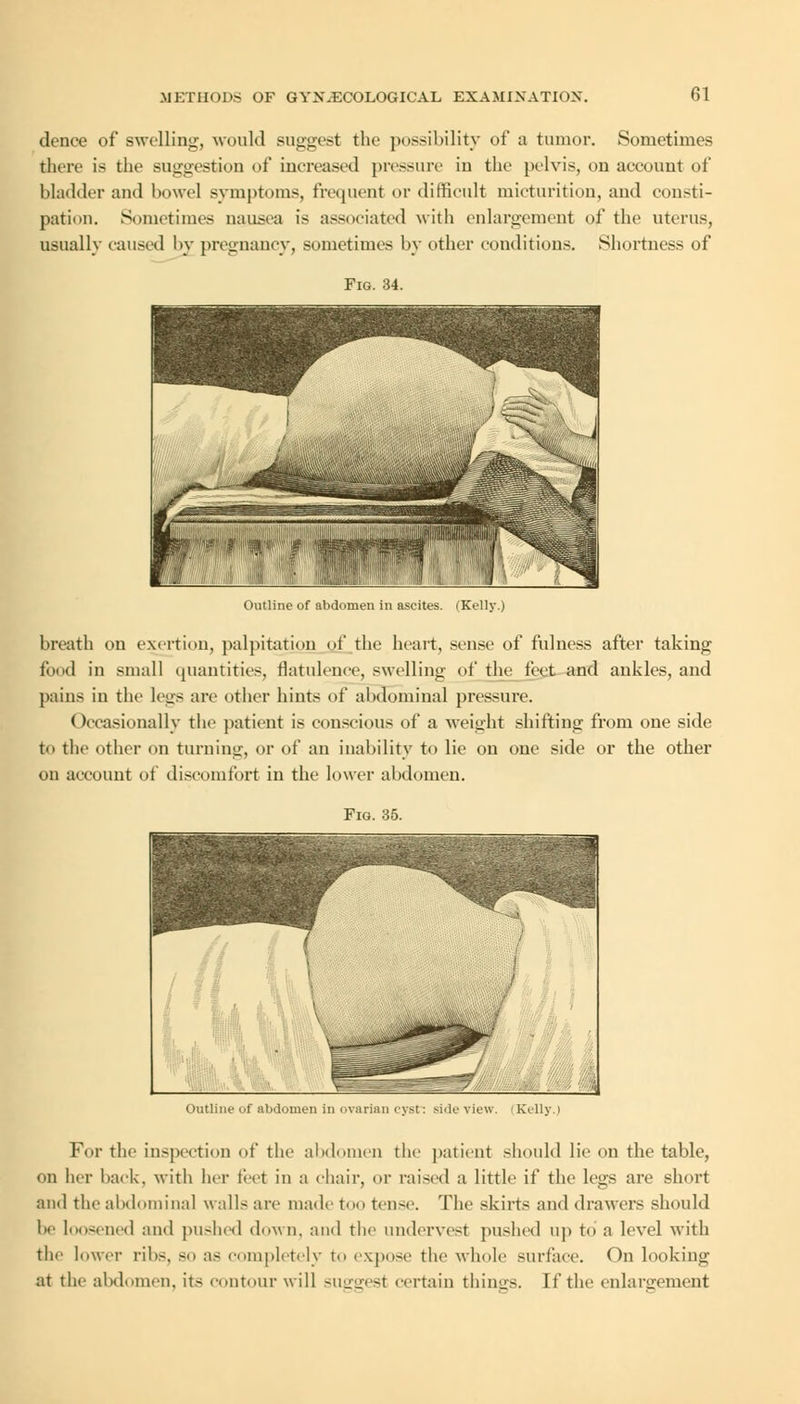 dence of swelling, would suggest the possibility of a tumor. Sometimes there is the suggestion of increased pressure in the pelvis, on account of bladder and bowel symptoms, frequent or difficult micturition, and consti- pation. Sometimes nausea is associated with enlargement of the uterus, usually caused by pregnancy, sometimes by other conditions. Shortness of Fig. 34. Outline of abdomen in ascites. (Kelly.) breath on exertion, palpitation of the heart, sense of fulness after taking food in small quantities, flatulence, swelling of the feet and ankles, and pains in the legs are other hints of abdominal pressure. Occasionally the patient is conscious of a weight shifting from one side to the other on turning, or of an inability to lie on one side or the other on account of discomfort in the lower abdomen. Fig. 35. Outline of abdomen in ovarian cyst: side view. Kelly.) For the inspection of the abdomen the patient should lie on the table, on her back, with her feet in a chair, or raised a little if the legs are short ami the abdominal walls are made too tense. The skirts and drawers should he loosened and pushed down, and the undervest pushed up to a level with the lower ribs, so as completely to expose the whole surface. On looking at the abdomen, its contour will suggest certain things. If the enlargement