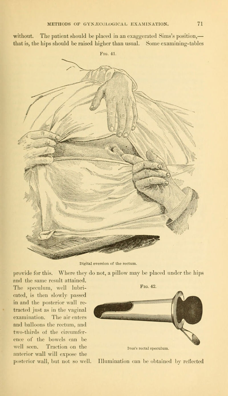 without. The patient should be placed in an exaggerated Sims's position,— that is, the hips should be raised higher than usual. Some examining-tables Fig. 41. Digital eversion of the rectum. provide for this. Where they do not, a pillow may be placed under the hips and the same result attained. The speculum, well lubri- Fig. 42. cated, is then slowly passed in and the posterior wall re- tracted just as in the vaginal examination. The air enters and balloons the rectum, and two-thirds <>i the circumfer- ence of the bowels can be well seen. Traction on the anterior wall will expose the posterior wall, but not so well. Ives's rectal speculum. Illumination can be obtained by reflected