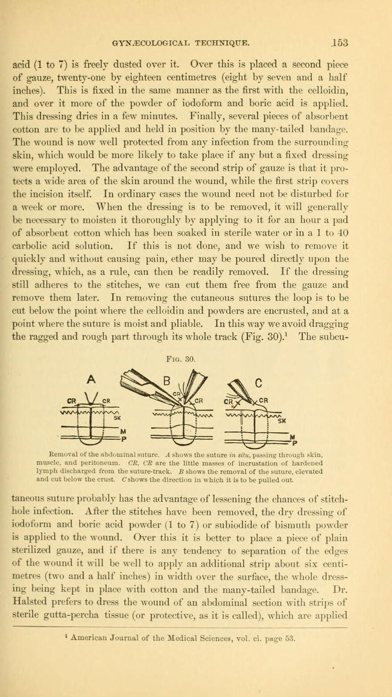 acid (1 to 7) is freely dusted over it. Over this is placed a second piece of gauze, twenty-one by eighteen centimetres (eight by seven and a half inches). This is fixed in the same manner as the first with the celloidin, and over it more of the powder of iodoform and boric acid is applied. This dressing dries in a few minutes. Finally, several pieces of absorbent cotton are to be applied and held in position by the many-tailed bandage. The wound is now well protected from any infection from the surrounding skin, which would be more likely to take place if any but a fixed dressing were employed. The advantage of the second strip of gauze is that it pro- tects a wide area of the skin around the wound, while the first strip covers the incision itself. In ordinary cases the wound need not be disturbed for a week or more. When the dressing is to be removed, it will generally be necessary to moisten it thoroughly by applying to it for an hour a pad of absorbent cotton which has been soaked in sterile water or in a 1 to 40 carbolic acid solution. If this is not done, and we wish to remove it quickly and without causing pain, ether may be poured directly upon the dressing, which, as a rule, can then be readily removed. If the dressing still adheres to the stitches, we can cut them free from the gauze and remove them later. In removing the cutaneous sutures the loop is to be cut below the point where the celloidin and powders are encrusted, and at a point where the suture is moist and pliable. In this way we avoid dragging the ragged and rough part through its whole track (Fig. 30).1 The subcu- Fio. 30. ^±^~ Removal of the abdominal suture. A shows the suture in situ, passing through skin, muscle, and peritoneum. CR, CR are the little masses of incrustation of hardened lymph discharged from the suture-track. B shows the removal of the suture, elevated and cut below the crust. C shows the direction in which it is to be pulled out. taneous suture probably has the advantage of lessening the chances of stitch- hole infection. After the stitches have been removed, the dry dressing of iodoform and boric acid powder (1 to 7) or subiodide of bismuth powder is applied to the wound. Over this it is better to place a piece of plain sterilized gauze, and if there is any tendency to separation of the edges of the wound it will be well to apply an additional strip about six centi- metres (two and a half inches) in width over the surface, the whole dress- ing being kept in place with cotton and the many-tailed bandage. Dr. Halsted prefers to dress the wound of an abdominal section with strips of sterile gutta-percha tissue (or protective, as it is called), which are applied 1 American Journal of the Medical Sciences, vol. ci. page 53.