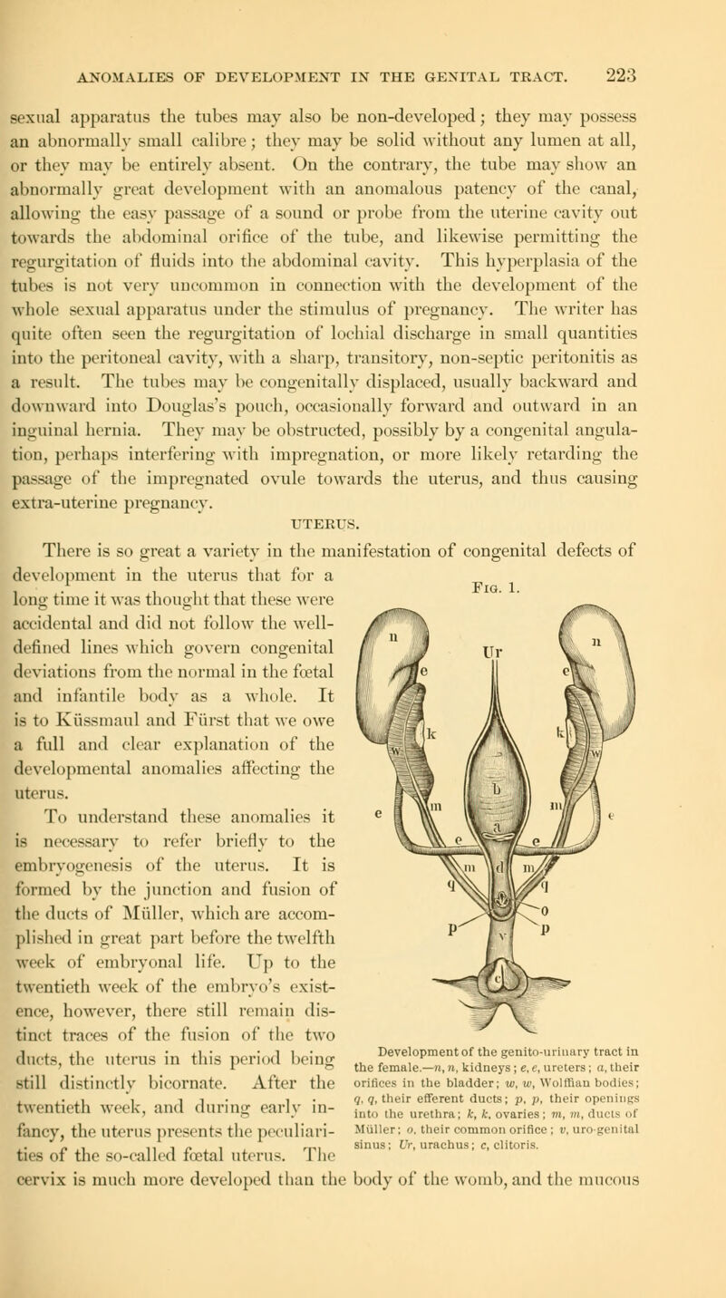 Fig. 1. sexual apparatus the tubes may also be non-developed; they may possess an abnormally small calibre ; they may be solid without any lumen at all, or they may be entirely absent. On the contrary, the tube may show an abnormally great development with an anomalous patency of the canal, allowing the easy passage of a sound or probe from the uterine cavity out towards the abdominal orifice of the tube, and likewise permitting the regurgitation of fluids into the abdominal cavity. This hyperplasia of the tubes is not very uncommon in connection with the development of the whole sexual apparatus under the stimulus of pregnancy. The writer has quite often seen the regurgitation of lochial discharge in small quantities into the peritoneal cavity, with a sharp, transitory, non-septic peritonitis as a result. The tubes may be congenitally displaced, usually backward and downward into Douglas's pouch, occasionally forward and outward in an inguinal hernia. They may be obstructed, possibly by a congenital angula- tion, perhaps interfering with impregnation, or more likely retarding the passage of the impregnated ovule towards the uterus, and thus causing extra-uterine pregnancy. UTERUS. There is so great a variety in the manifestation of congenital defects of development in the uterus that for a long time it was thought that these were accidental and did not follow the well- defined lines which govern congenital deviations from the normal in the foetal and infantile body as a whole. It is to Kiissmaul and Fiirst that we owe a full and clear explanation of the developmental anomalies affecting the uterus. To understand these anomalies it is necessary to refer briefly to the embrvogenesis of the uterus. It is formed by the junction and fusion of the ducts of Midler, which are accom- plished in great part before the twelfth week of embryonal life. Up to the twentieth week of the embryo's exist- ence, however, there still remain dis- tinct traces of the fusion of the two ducts, the uterus in this period being still distinctly bicornate. After the twentieth week, and during early in- fancy, the uterus presents the peculiari- ties of the so-called foetal uterus. The cervix is much more developed than the body of the womb, and the mucous Development of the genito-urinary tract in the female.—it, n, kidneys; e, e, ureters; a, their orifices in the bladder; w, w, Wolffian bodies; </. q, their efferent ducts; p, p, their openings Into (lie urethra; k, k, ovaries; m, m, ducts of (duller; o, their common orifice; v, urogenital sinus; Or, urachus; c, clitoris.