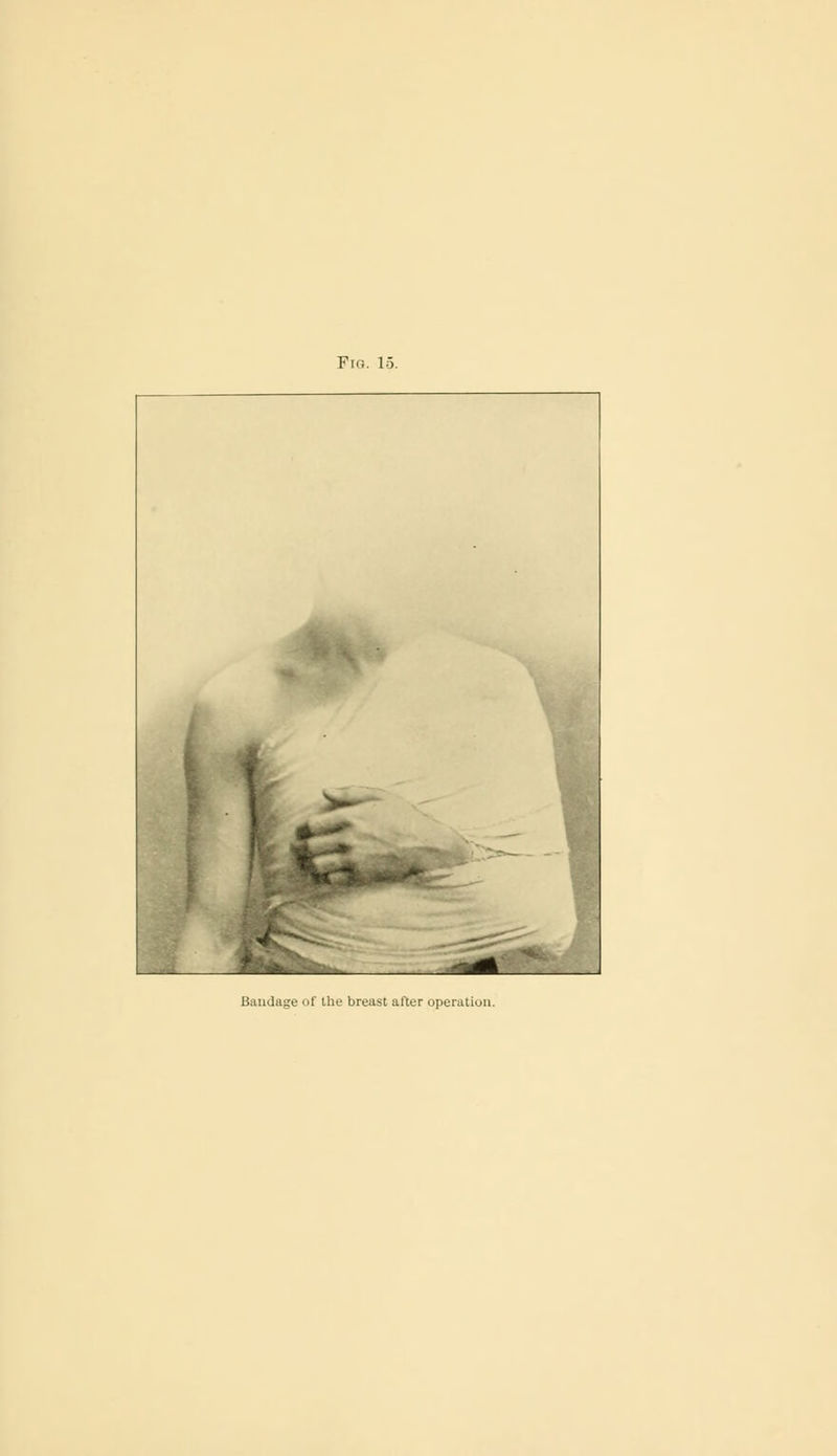 Fig. 15. # Bandage Of Ihe breast alter operation.