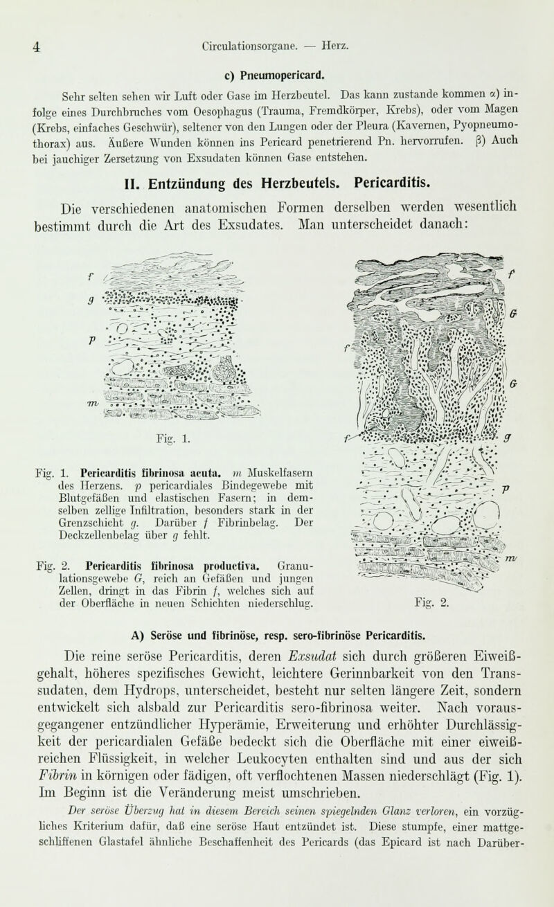 c) Pneumopericard. Sehr selten sehen wir Luft oder Gase im Herzbeutel. Das kann zustande kommen «) in- folge eines Durchbruches vom Oesophagus (Trauma, Fremdkörper, Krebs), oder vom Magen (Krebs, einfaches Geschwür), seltener von den Lungen oder der Pleura (Kavernen, Pyopneumo- thorax) aus. Äußere Wunden können ins Pericard penetrierend Pn. hervorrufen, ß) Auch bei jauchiger Zersetzung von Exsudaten können Gase entstehen. II. Entzündung des Herzbeutels. Pericarditis. Die verschiedenen anatomischen Formen derselben werden wesentlich bestimmt durch die Art des Exsudates. Man unterscheidet danach: r -- ~^:^::f-'~' :- - 3 v?.-?l#f'%^4v:Vö-.Ä>.feä' '*• «-?r' — ov_. . • .*r,v. * -^ c-»—•' s- ~ ~ »\Z\\ '^S^SSi^? V :vJ-SäS::'-: Fig. 1. Fig. 1. Pericarditis öbrinosa acuta, m Muskelfasern des Herzens, p perieardiales Bindegewebe mit Blutgefäßen und elastischen Fasern; in dem- selben zellige Infiltration, besonders stark m der Grenzschicht g. Darüber / Fibrinbelag. Der Deckzellenbelag über g fehlt. Fig. 2. Pericarditis fibrinöse productiva. Granu- lationsgewebe G, reich an Gefäßen und jungen Zellen, dringt in das Fibrin /, welches sich auf der Oberfläche in neuen Schichten niederschlug. mmmmm rm Fig. 2. A) Seröse und fibrinöse, resp. sero-fibrinöse Pericarditis. Die reine seröse Pericarditis, deren Exsudat sich durch größeren Eiweiß- gehalt, höheres spezifisches Gewicht, leichtere Gerinnbarkeit von den Trans- sudaten, dem Hydrops, unterscheidet, besteht nur selten längere Zeit, sondern entwickelt sich alsbald zur Pericarditis sero-nbrinosa weiter. Nach voraus- gegangener entzündlicher Hyperämie, Erweiterung und erhöhter Durchlässig- keit der pericardialen Gefäße bedeckt sich die Oberfläche mit einer eiweiß- reichen Flüssigkeit, in welcher Leukocyten enthalten sind und aus der sich Fibrin in körnigen oder fädigen, oft verflochtenen Massen niederschlägt (Fig. 1). Im Beginn ist die Veränderung meist umschrieben. Der seröse Überzug hat in diesem Bereich seinen spiegelnden Glanz verloren, ein vorzüg- liches Kriterium dafür, daß eine seröse Haut entzündet ist. Diese stumpfe, einer mattge- schliffenen Glastafel ähnliche Beschaffenheit des Pericards (das Epicard ist nach Darüber-