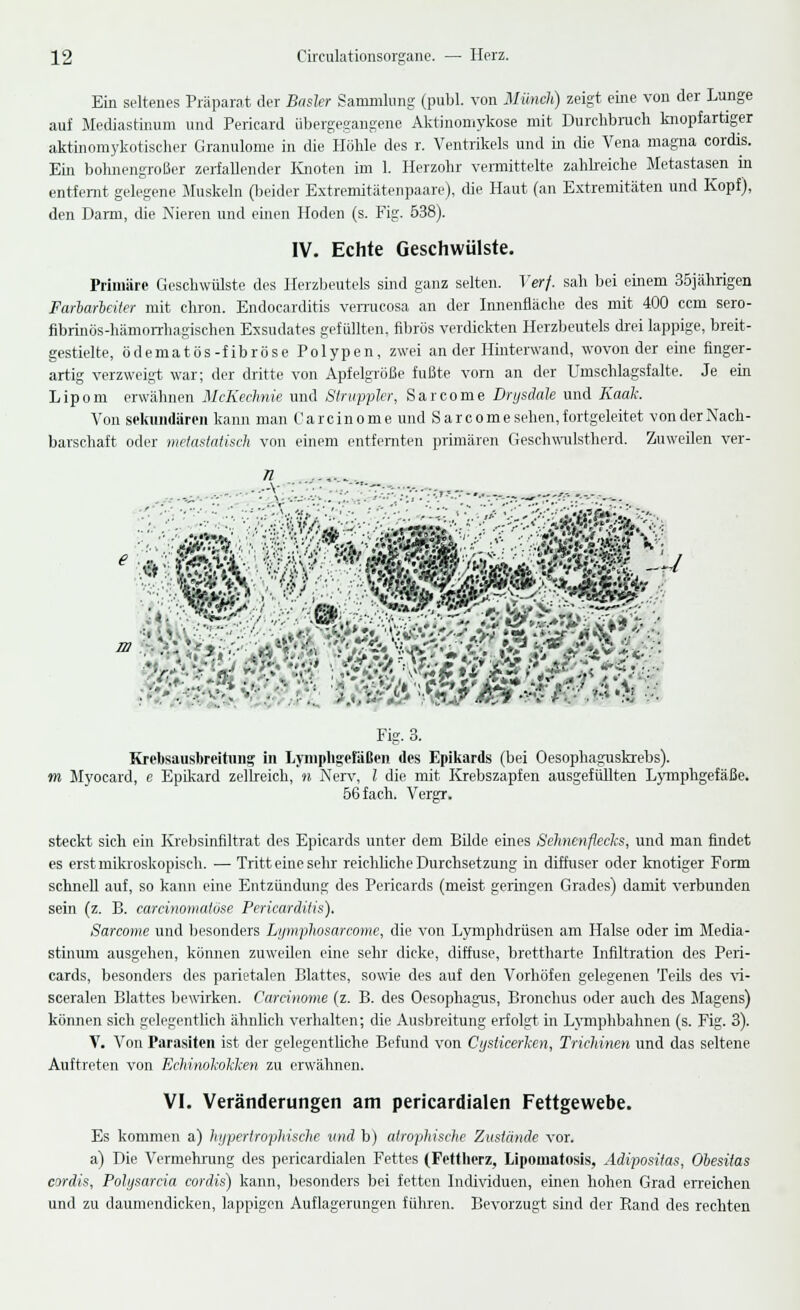 Ein seltenes Präparat der Basler Sammlung (publ. von Miinch) zeigt eine von der Lunge auf Mediastinum und Pericard übergegangene Aktinomykose mit Durchbrach knopfartiger aktinomykotischer Granulome in die Höhle des r. Ventrikels und in die Vena magna cordis. Ein bohnengroßer zerfallender Knoten im 1. Herzohr vermittelte zahlreiche Metastasen in entfernt gelegene Muskeln (beider Extremitätenpaare), die Haut (an Extremitäten und Kopf), den Darm, die Nieren und einen Hoden (s. Fig. 538). IV. Echte Geschwülste. Primäre Geschwülste des Herzbeutels sind ganz selten. Verf. sah bei einem 35jährigen Farbarbeiter mit chron. Endocarditis verrucosa an der Innenfläche des mit 400 ccm sero- fibrinös-hämorrhagischen Exsudates gefüllten, fibrös verdickten Herzbeutels drei lappige, breit- gestielte, ödematös-fibröse Polypen, zwei an der Hinterwand, wovon der eine finger- artig verzweigt war; der dritte von Apfelgröße fußte vom an der Umschlagsfalte. Je ein Lipom erwähnen McKechnie und Siruppier, Sarcome Drysdale und Kaak. Von sekundären kann man Carcinome und Sarcome sehen, fortgeleitet von der Nach- barschaft oder metastatisch von einem entfernten primären Geschwulstherd. Zuweilen ver- Fig. 3. Krobsausbreitung in Lymphgefäßen des Epikards (bei Oesophaguskrebs). m Myocard, c Epikard zellreich, n Nerv, l die mit Krebszapfen ausgefüllten Lymphgefäße. 56 fach. Vergr. steckt sich ein Krebsinfiltrat des Epicards unter dem Bilde eines Sehnenflecks, und man findet es erst mikroskopisch. — Tritt eine sehr reichliche Durchsetzung in diffuser oder knotiger Form schnell auf, so kann eine Entzündung des Pericards (meist gelingen Grades) damit verbunden sein (z. B. cardnomatöse Pericardiiis). Sarcome und besonders Lymphosarcome, die von Lymphdrüsen am Halse oder im Media- stinum ausgehen, können zuweilen eine sehr dicke, diffuse, brettharte Infiltration des Peri- cards, besonders des parietalen Blattes, sowie des auf den Vorhöfen gelegenen Teils des vi- sceralen Blattes bewirken. Carcinome (z. B. des Oesophagus, Bronchus oder auch des Magens) können sich gelegentlich ähnlich verhalten; die Ausbreitung erfolgt in Lymphbahnen (s. Fig. 3). V. Von Parasiten ist der gelegentliehe Befund von Cysiicerken, Trichinen und das seltene Auftreten von Echinokokken zu erwähnen. VI. Veränderungen am pericardialen Fettgewebe. Es kommen a) hypertrophische und b) atrophische Zustände vor. a) Die Vermehrung des pericardialen Fettes (Fettherz, Lipomatosis, Adipositas, Obesitas cordis, Polysarcia cordis) kann, besonders bei fetten Individuen, einen hohen Grad erreichen und zu daumendicken, lappigen Auflagerungen führen. Bevorzugt sind der Rand des rechten