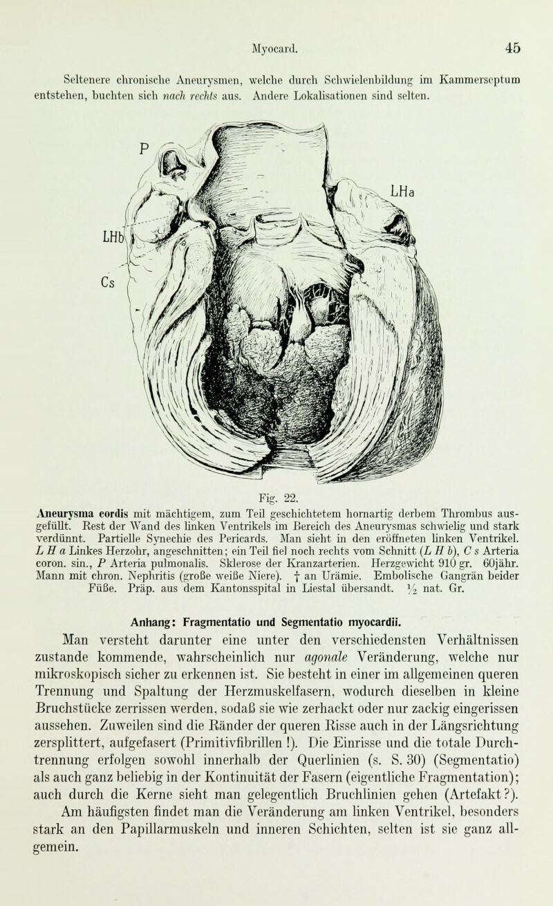 Seltenere chronische Aneurysmen, welche durch Schwielenbildung im Kammerseptum entstehen, buchten sich nach rechts aus. Andere Lokalisationen sind selten. Fig. 22. Aneurysma cordis mit mächtigem, zum Teil geschichtetem homartig derbem Thrombus aus- gefüllt. Rest der Wand des linken Ventrikels im Bereich des Aneurysmas schwielig und stark verdünnt. Partielle Synechie des Pericards. Man sieht in den eröffneten linken Ventrikel. LH a Linkes Herzohr, angeschnitten; ein Teil fiel noch rechts vom Schnitt (L H h), C s Arteria coron. sin., P Arteria pulmonalis. Sklerose der Kranzarterien. Herzgewicht 910 gr. 60jähr. Mann mit chron. Nephritis (große weiße Niere), f an Urämie. Embolische Gangrän beider Füße. Präp. aus dem Kantonsspital in Liestal übersandt. ]'i nat. Gr. Anhang: Fragmentatio und Segmentatio myocardii. Man versteht darunter eine unter den verschiedensten Verhältnissen zustande kommende, wahrscheinlich nur agonale Veränderung, welche nur mikroskopisch sicher zu erkennen ist. Sie besteht in einer im allgemeinen queren Trennimg und Spaltung der Herzmuskelfasern, wodurch dieselben in kleine Bruchstücke zerrissen werden, sodaß sie wie zerhackt oder nur zackig eingerissen aussehen. Zuweilen sind die Bänder der queren Bisse auch in der Längsrichtung zersplittert, aufgefasert (Primitivfibrillen !). Die Einrisse und die totale Durch- trennung erfolgen sowohl innerhalb der Querlinien (s. S. 30) (Segmentatio) als auch ganz beliebig in der Kontinuität der Fasern (eigentliche Fragmentation); auch durch die Kerne sieht man gelegentlich Bruchlinien gehen (Artefakt?). Am häufigsten findet man die Veränderung am linken Ventrikel, besonders stark an den Papillarmuskeln und inneren Schichten, selten ist sie ganz all- gemein.