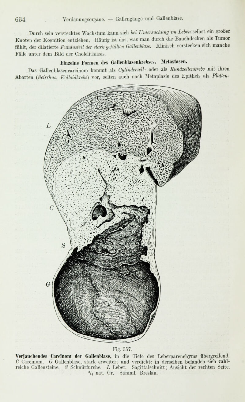 Durch sein verstecktes Wachstum kann sich bei Untersuchimg im Leben selbst ein großer Knoten der Kognition entziehen. Häufig ist das, was man durch die Bauchdecken als Tumor fühlt, der diktierte Fundusteil der stark gefüllten Gallenblase. Klinisch verstecken sich manche Fälle unter dem Bild dar Cholelithiasis. Einzelne Formen des Gallenblasenkrebses. Metastasen. Das Gallenblasencarcinom kommt als Cylinderzell- oder als Rundzellenkrebs mit ihren Abarten (Scirrhus, Kolloidkrebs) vor, selten auch nach Metaplasie des Epithels als Platten- Fig. 357. Versuchendes Careinom der Gallenblase, in die Tiefe des Leberparenchyms übergreifend. C Careinom. 0 Gallenblase, stark erweitert und verdickt; in derselben befanden sich zahl- reiche Gallensteine. S Schnürfurche. L Leber. Sagittalschnitt; Ansicht der rechten Seite. 3U nat. Gr. Samml. Breslau.