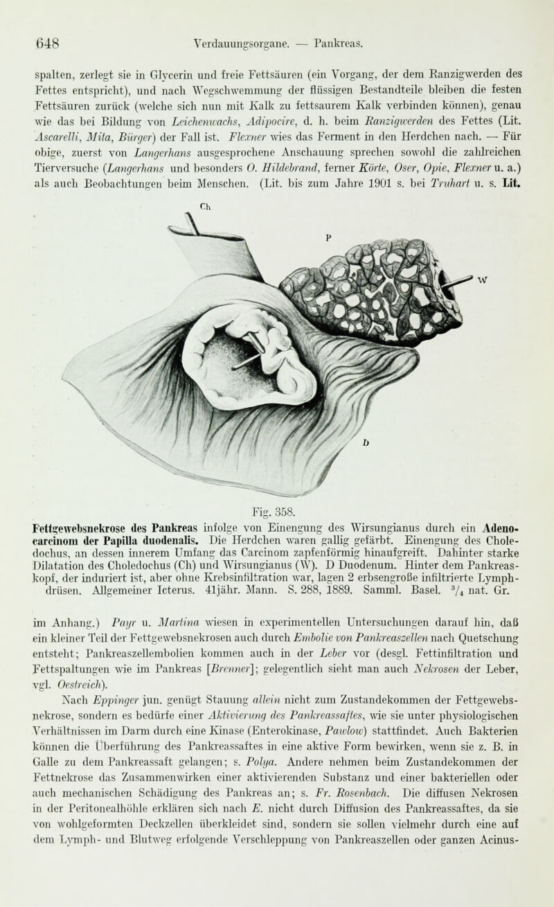spalten, zerlegt sie in Glyeerin und freie Fettsäuren (ein Vorgang, der dem Ranzigwerden des Fettes entspricht), und nach Wegschwemmung der flüssigen Bestandteile bleiben die festen Fettsäuren zurück (welche sich nun mit Kalk zu fettsaurem Kalk verbinden können), genau wie das bei Bildung von Leichenwachs, Adipocire, d. h. beim Banziejiverden des Fettes (Lit. Ascarelli, Mita, Bürger) der Fall ist. Flexner wies das Ferment in den Herdchen nach. — Für obige, zuerst von Langerhans ausgesprochene Anschauung sprechen sowohl die zaldreichen Tierversuche (Langerhans und besonders 0. Hildebrand, ferner Körte, Oser, Opie, Flexner u. a.) als auch Beobachtungen beim Menschen. (Lit. bis zum Jahre 1901 s. bei Truhart u. s. Lit. Fig. 358. Fettgewebsnekrosc des Pankreas infolge von Einengung des Wirsungianus durch ein Adeno- carcinom der Papilla duodenalis. Die Herdchen waren gallig gefärbt. Einengung des Chole- dochus, an dessen innerem Umfang das Carcinom zapfenförmig hinaufgreift. Dahinter starke Dilatation des Choledochus (Ch) und Wirsungianus (W). D Duodenum. Hinter dem Pankreas- kopf, der induriert ist, aber ohne Krebsinfiltration war, lagen 2 erbsengroße infiltrierte Lymph- drüsen. Allgemeiner Icterus. 41jähr. Mann. S. 288, 1889. Samml. Basel. 3/4 nat. Gr. im Anhang.) Payr u. Martina wiesen in experimentellen Untersuchungen darauf hin, daß ein kleiner Teil der Fettgewebsnekrosen auch durch Embolie von Panhreassellen nach Quetschung entsteht; Pankreaszellembolien kommen auch in der Leber vor (desgl. Fettinfiltration und Fettspaltungen wie im Pankreas [Brenner]; gelegentlich sieht man auch Nekrosen der Leber, vgl. Oestreich). Nach Eppinger jun. genügt Stauung allein nicht zum Zustandekommen der Fettgewebs- nekrose, sondern es bedürfe einer Aktivierung des Pankreassaftes, wie sie unter physiologischen Verhältnissen im Dann durch eine Kinase (Enterokinase, Pawloiv) stattfindet. Auch Bakterien können die Überführung des Pankreassaftes in eine aktive Forrn bewirken, wenn sie z. B. in Galle zu dem Pankreassaft gelangen; s. Polya. Andere nehmen beim Zustandekommen der Fettnekrose das Zusammenwirken einer aktivierenden Substanz und einer bakteriellen oder auch mechanischen Schädigung des Pankreas an; s. Fr. Rosenbach. Die diffusen Nekrosen in der Peritonealhöhle erklären sich nach E. nicht durch Diffusion des Pankreassaftes, da sie von wohlgeformten Deckzellen überkleidet sind, sondern sie sollen vielmehr durch eine auf dem Lymph- und Blutweg erfolgende Verschleppung von Pankreaszellen oder ganzen Acinus-
