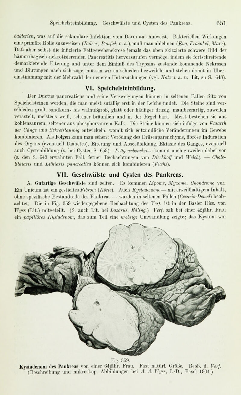 lakterien, was auf die sekundäre Infektion vom Darm aus Hinweist. Bakteriellen Wirkungen eine primäre Rolle zuzuweisen (Baiser, Ponfick u. a.), muß man ablehnen (Eng. Fraenkel, Marx). Daß aber selbst die infizierte Fettgewebsnekrose jemals das oben skizzierte schwere Bild der hämorrhagisch-nekrotisierenden Pancreatitis hervorzurufen vermöge, indem sie fortschreitende demarkierende Eiterung und unter dem Einfluß des Trypsins zustande kommende Nekrosen und Blutungen nach sich zöge, müssen wir entschieden bezweifeln und stehen damit in Über- einstimmung mit der Mehrzahl der neueren Untersuchungen (vgl. Kais u. a. u. Lit. zu S. 648). VI. Speichelsteinbildung. Der Ductus pancreaticus und seine Verzweigungen können in seltenen Fällen Sitz von Speichelsteinen werden, die man meist zufällig erst in der Leiche findet. Die Steine sind ver- schieden groß, Sandkorn- bis walnußgroß, glatt oder häufiger drusig, maulbeerartig, zuweilen verästelt, meistens weiß, seltener bräunlich und in der Regel hart. Meist bestehen sie aus kohlensaurem, seltener aus phosphorsaurem Kalk. Die Steine können sich infolge von Katarrh der Gänge und Sekretslauimg entwickeln, womit sich entzündliehe Veränderungen im Gewebe kombinieren. Als Folgen kann man sehen: Verödung des Drüsenparenchyms, fibröse Induration des Organs (eventuell Diabetes), Eiterung und Absceßbildung, Ektasie des Ganges, eventuell auch Cystenbildung (s. bei Cysten S. 653). Fettgewebsnekrose kommt auch zuweilen dabei vor (s. den S. 649 erwähnten Fall, ferner Beobachtungen von Dieckhofj und Welch). — Chole- lithiasis und Lithiasis pancrealiea können sich kombinieren (Fuchs). VII. Geschwülste und Cysten des Pankreas. A. Gutartige Geschwülste sind selten. Es kommen Lipome, Myxome, Chondrome vor. Ein Unicum ist ein gestieltes Fibrom (Körte). Auch Kystadenome — mit eiweißhaltigem Inhalt, ohne spezifische Bestandteile des Pankreas — wurden in seltenen Fällen (Cesaris-Demel) beob- achtet. Die in Fig. 359 wiedergegebene Beobachtung des Verf. ist in der Basler Diss. von Wyss (Lit.) mitgeteilt. (S. auch Lit. bei Lazarus, Edling.) Verf. sah bei einer 42jähr. Frau ein papilläres Kystadenom, das zum Teil eine krebsige Umwandlung zeigte; das Kystom war Fig. 359. Kystadenom des Pankreas von einer 64jähr. Frau. Fast natürl. Größe. Beob. d. Verf. (Beschreibung und mikroskop. Abbildungen bei A. A. Wyss, I.-D., Basel 1904.)