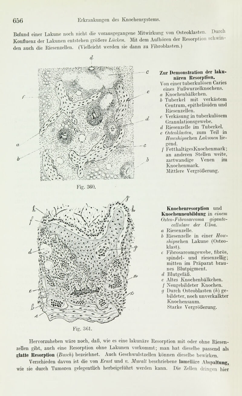 Befund einer Lakune noch nicht die vorausgegangene Mitwirkung von Osteoklasten. Durch Konfluenz der Lakunen entstehen größere Lücken. Mit dem Auihoren der Resorption schwm- den auch die Riesenzelh^n. (Vielleicht werden sie dann zu Fibroblasten.) ^ ?5 :5or?oC. Fig. 360. d Zur Deinoiistration der lakii- iiäreii Resorptiflii. Von einer tuljerkulüsen Caries eines Fußwurzelknochens. a KnochcnbäU^chen. b Tuljerkel mit verkästem Centrum, epitheüoiden und Riesenzellen. c Verkäsung in tuberkulösem Granulationsgewebe. d Riesenzelle im Tuljerkel. e OsteolAasien, zum Teil in Howshipschen Lakunen lie- gend. / FetthaltigesKnochenmark; an anderen Stellen weite, zaitwandige Venen im Knochenmark. Mittlere Vergrößerung. Knochenresorptioii und Kiiocheiineubildung in einem Osteo- Fxhrnsarcoma giganto- cellidare der Ulna. a Riesenzelle. b Riesenzelle iir einer How- .s/(t;jsclien Lakune (Osteo- klast). c Fibrosarconigewebe, fibrös, Spindel- und riesenzellig; mitten im Präparat brau- nes Blutpigment. d Blutgefäß. e Altes Knochenbälkchen. / Neugebildeter Knochen. g Durch Osteoblasten (h) ge- bildeter, noch unverkaufter Knochensaum. .Starke Vergrößerung. Fig. 3G1. Her-\'orzuheben wäre noch, daß, wie es eine lakunäre Resorption mit oder ohne Riesen- zeEen gibt, auch eme Resorption ohne Lakunen vorkommt; man hat dieselbe passend als glatte Resorption {Busch) bezeichnet. Auch GeschwiüstzeUen können dieselbe bewirken. Verschieden davon ist die von Ernst und v. Muralt beschriebene laraelläre Abspaltung wie sie durch Tumoren gelegentlich herbeigeführt werden kann. Die Zellen dringen hier