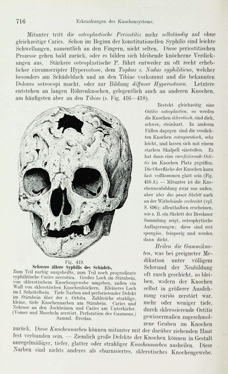 VSt 1^-^-^ i\Iitunter tritt die osteoplastische Periostitis mehr sethstmidig auf o]ine gleichzeitige Caries. Schon im Beginn der konstitutionellen Syphilis sind leichte Schwelhuigen, namentlich an den Fingern, nicht selten. Diese periostitischen Prozesse gehen bald zurück, oder es bilden sich bleibende knöcherne Verdick- ungen aus. Stärkere osteoplastische P. führt entweder zu oft recht erheb- licher circumscripter Hyijerostose, dem Tophus s. Nodus sijpkiliticus, welcher besonders am Schädeldach und an den Tibiae vorkommt und die bekannten Dolores osteocopi macht, oder zur Bildung diffuser Hijperostosen. Letztere entstehen an langen Eöhrenlmochen, gelegentlieh auch an anderen Knochen, am häufigsten aber an den Tiiiae (s. Fig. 416—418). Besteht gleichzeitig eme Ostitis osteoplastica, so werden die Knochen sklerotisch, sind dick, schwer, steinhart. In anderen Fällen dagegen sind (he verdick- ten Ivnochen osteopowHsch, sehr leicht, nnd lassen sich mit einem starken Skalpell einstoßen. Es hat dann eine rarefizierende Osti- tis im Ivnochen Platz gegriffen. Die Oberfläche der ICnochen kann fast vollkommen glatt sein (Fig. 416 A). — ilitimter ist die lüio- chennenbildung zwar nur außen, aber über das ganze Skelett auch an der Wu'belsäule veiireitet (vgl. S. 696); allenthalben erscheinen, wie z. B. cm Skelett der Breslauer Sammhmg zeigt, osteophytische Auflager-ungen; diese sind erst spongiös, fernporig und werden dann dicht. Heilen die Gummikno- ten, was bei geeigneter Me- dikation unter völligem Schwinid der Xeubilduug oft rasch geschieht, so blei- ben, wofern der Knochen selbst in größerer Ausdeh- nung cariös zerstört war, mehr oder weniger tiefe, durch sklerosierende Ostitis gewissermaßen zugeschmol- zene Gruben im Knochen zurück. Diese Knochennarien können mitunter mit der darüber ziehenden Haut fest verbunden sein. — Ziemlich große Defekte der Knochen können in Gestalt unregehiiäßiger, tiefer, glatter oder strahliger Knocliennarben ausheilen. Diese Narben sind nichts anderes als eburnisiertes, sklerotisches Knochengewebe. Fig. 419. Scliwere ältere Syphilis des Scliädels. Zum Teil narbig ausgeheUte, zum Teil noch jirogrediente sj^hilitische Caries necrotica. Großes Loch im Stirnbem, von sklerotischem Ivnochengewebe umgeben, außen ein Wall von sklerotischen Knochenhöckern. Kleineres Locli im 1. Scheitelbein. Tiefe Narben und perforierender Defekt im Stirnbein über der r. Orbita. Zahlreiche strahligc, kleüie, tiefe Knochennarben am Stirnbein. Caries und Nekrose an den Jochbeinen und Caries am Unterkiefer. (Vomer und iluschehi zerstört, Perforation des Gaumens.) Samml. Breslau.