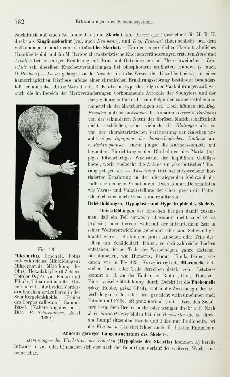 Nachdnick auf einen Zusammenliang mit Skorbut hin. Looser (Lit.) bezeiclinet die M. B. K. dü'elct als Säugliiigsskorbut (vgl. auch XeumcDuij, und Eng. Fraenkel (Lit.) sehließt sich dem vollkommen an und nennt sie hilantilcii Skorbut. — Ein dem menschlichen Skorbut älmliches Krankheitsbild und fürM. Barlow charakteristische Iviiochenveränderangen erzielten fiofei und Fröhlich bei eruseitiger Ernähmng mit Brot und Getreidearten bei Meerschweinchen; Ldp- schütz sah dieselben lüiochenveräuderungen bei phosphorarm ernährten Hunden (s. auch 0. Heitbner). — Looser gelangte zu derAnsiclit, daß das Wesen der lü-ankheit einzig in einer hämorrhagischen Diathese infolge einer chronischen Ernälrnxngsstörung bestände; besonders faßt er auch das fibröse Mark der M. B. K. als eure tyinsche Folge der Jlarkblutungen auf, wie auch die im Bereich der Marlcverändeningen vorkommende Atrophie der Spongiosa imd der dazu gehörigen Corticabs eine Folge der subperiostalen und namentlich der Markblutungen sei. Doch können sich Eug. Fraenkel imd ebenso Schmorl der Annahme Looser's {Barlow''s) von der sekundären Natur der fibrösen Markbeschaffeuheit nicht ansclrließen, sehen viehnehr die Blutungen als eia von der charakteristischen Veränderung der Ivnochen un- abhängiges Symptom der hämorrhagischen Diathese an. '(!. EceMinghausen lenkte jüngst die Aufmerksamkeit auf besondere Einrichtungen der Blutbahnen des Marks (üp- piges büschelartiges Wachstum der kapUlären Gefäßge- biete), woiin vielleicht die Anlage zur ,skorbutisclien' Blu- tung gelegen sei. — Ausheilung tritt bei entsprechend kor- rigierter Ernälrrung in der ülierwiegendcn Mehrzahl der Fälle nach eüiigen Monaten em. Doch können Deformitäten wie Varus- und Valgusstellung der Ober- gegen die Unter- schenkel oder auch Coxa vara resultieren. Defektbildungen, Hypoplasie und Hypertrophie des Skeletts. Detektbildiuiffcn der lüioehen hängen damit zusam- men, daß ein Ted entweder überhaupt nicht angelegt ist (Aplasie) oder bereits während der intrauteiinen Zeit m semer Weiterentwicklung gehemmt oder zum Sehwund ge- bracht wurde. So können ganze Knochen oder Teile der- selben am Schädeldach fehlen, so daß zahlreiche Lücken entstehen, ferner Teile der Wirbelbögen, ganze Extremi- tätenloiochen, me Humerus, Femur-, Fibiüa fehlen, wo- dui-ch me in Fig. 429, Kurzgliedrigkeit, Mikromelie ent- stehen kann, oder Teile derselben defekt sein. Letzteres kommt z. B. an den Enden von Radius, LUna, Tibia vor. Eine t\i)ische Mißbddung durch Defekt ist die Phokomelie tfiüy.Y) Robbe, fj.eXos Glied), wobei die Zwischenglieder äu- ßerlich gar nicht oder fast gar nicht walu'zunehmen sind; Hände und Füße, oft ganz normal groß, sitzen den Schul- tern resp. dem Becken mehr oder weniger dkekt auf. Nach J. 0. Saint-Hilaire bilden bei der Hemimelie die so direkt am Rumpf sitzenden Hände und Füße nur Rudimente, bei der Ektromelie (Amelie) fehlen auch die letzten Rudimente. Abnorm geringes Längenwachstum des Skeletts. Hemmungen des Wachstums der Knochen (Hypoplasie des Skeletts) kommen a) bereits intrauterm vor, oder b) machen sich erst nach der Geburt im Verlauf des weiteren Wachstums bemerkbar. Fig. 429. Slikromelus, 6 moiiatl. Fötus nüt zahheichen Mißlnldungen: Mifa-ognathie, Mißbildung des 01irs,Hexadaktylie (6 Zehen). Totaler Defekt von Femur und Fibula; Tibia rudimentär. Hu- merus fehlt, die beiden Vorder- armlniochen artikulieren in der Schultergelenkhöhle. (Fehlen des Corpus caUosum.) Samml. Basel. (Nähere Angaben in L- Diss. B. Schwendener, Basel 1899.)