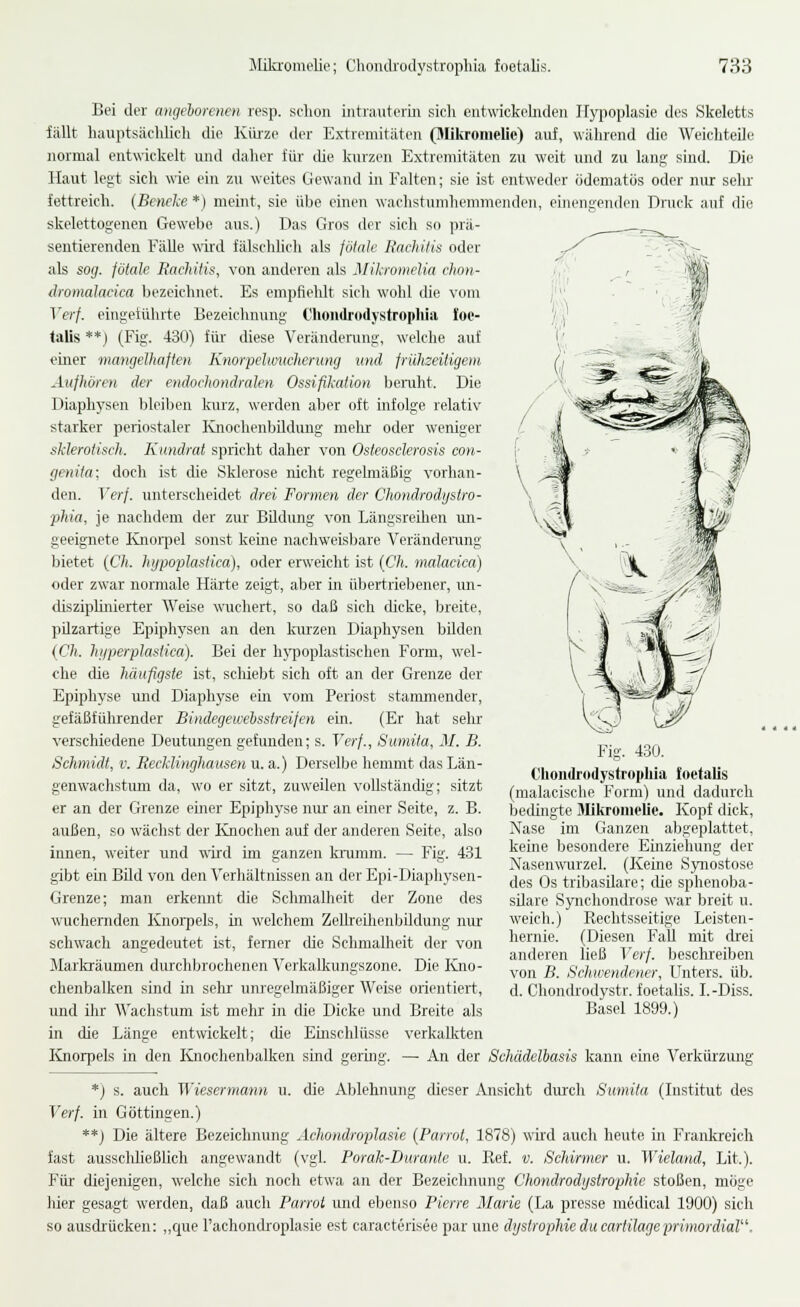 Bei der angeborenen resp. schon intrauterm sicli cntwickehiden Hypoplasie des Skeletts iällt hauptsächlich die Kürze der Extremitäten (Mikronielie) auf, wälirend die Weichteile normal entwickelt und daher für die kurzen Extremitäten zu weit und zu lang sind. Die Haut legt sich wie ein zu weites Gewand in Falten; sie ist entweder ödematos oder niu: sehr fettreich. (Bcncke *) meint, sie übe einen wachstnmhenimenden skelettogenen Gewebe aus.) Das Gros der sich so prä- sentierenden Fälle wird fälschlich als fötale Rachitis oder als sog. fötale Rachitis, von anderen als Milionielia chon- dromalacica bezeichnet. Es empfielilt sich wohl die vom Verf. eingetührte Bezeichnung Chondrodystrophia foe- talis **) (Fig. 430) füi' diese Veränderung, welche auf einer mangelhaften Knorpelivucherung und früheeitigem Aufhören der endochondralen Ossifikation benüit. Die Diaphysen bleiben kurz, werden aber oft infolge relativ starker periostaler Ivuochenbildung melir oder weniger sklerotisch. Kundrat spricht daher von Osteosclerosis con- genita; doch ist die Sklerose nicht regelmäßig vorhan- den. Verf. unterscheidet drei Formen der Chondrodystro- phia, je naclidem der zur BUdung von Längsreihen un- geeignete Knoipel sonst keine nachweisbare Verändemng bietet {Ch. hypoplastica), oder erweicht ist {Ch. malacica) disziplinierter Weise wuchert, so daß sich dicke, breite, pUzartige Epiphysen an den kurzen Diaphysen bilden {Ch. hifperplasiica). Bei der liN-poplastischen Form, wel- che die häufigste ist, scliiebt sicli oft an der Grenze der Epiphyse und Diaphyse ein vom Periost stammender, gefäßfülrrender Bindegewebsstreifen ein. (Er hat selir verschiedene Deutungen gefunden; s. Verf., Suniita, M. B. Schmidt, v. Recklinghausen u. a.) Derselbe hemmt das Län- genwachstum da, wo er sitzt, zuweilen vollständig; sitzt er an der Grenze einer Epiphj'se mrr an einer Seite, z. B. außen, so wächst der Knochen auf der anderen Seite, also innen, weiter und wird im ganzen krumm. — Fig. 431 gibt ein Bild von den Verhältnissen an der Epi-Diaphysen- Grenze; man erkennt die Schmalheit der Zone des wuchernden Knorpels, in welchem ZeUreOieiÜjildung nm- schwach angedeutet ist, ferner die Schmalheit der von Markräumen durchbrochenen Verkalkungszone. Die Kno- chenbalken sind in selir unregelmäßiger Weise orientiert, und ihr Wachstum ist mehr in die Dicke und Breite als einengenden Druck auf die Fig. 430. Clioiidrodystrophia foetalis (malacische Form) und dadurch bedingte Mikronielie. Kopf dick, Nase im Ganzen abgeplattet, keine besondere Einziehung der Nasenwurzel. (Keine Synostose des ÖS tribasilare; die sphenoba- silare Synchondrose war breit u. weich.) Rechtsseitige Leisten- hernie. (Diesen Fall mit drei anderen ließ Verf. besclu'eiben von B. Schwendener, Unters, üb. d. Chondrodystr. foetalis. I.-Diss. Basel 1899.) in die Länge entwickelt; die Emschlüsse verkalkten Knorpels in den Knochenbalken sind geruig. — An der Schädelbasis kann eine Verkürzung *) s. auch Wiesermann u. die Ablehnung dieser Ansicht durch Sumita (Institut des Verf. in Göttingen.) **) Die ältere Bezeichnung .Icliondroplasie {Parrot, 1878) wird auch heute m Franki'eich fast ausschließlich angewandt (vgl. Porak-Durante u. Ref. v. Schirmer u. Wieland, Lit.). Für diejenigen, welche sich noch etwa an der Bezeichnung Chondrodijslrophic stoßen, möge hier gesagt werden, daß auch Parrot und ebenso Pierre Marie (La presse medical 1900) sich so ausdrücken: ,,que Fachondroplasie est caracterisee par une dijstrophieducartilageprimordial.