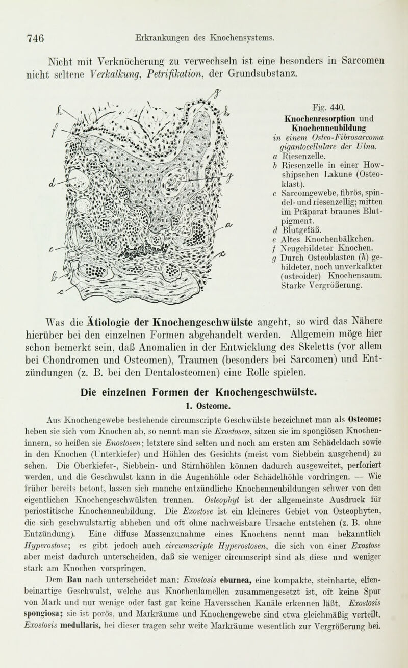 Nicht mit Verknöcherung zu verwechseln ist eine besonders in Sarcomen nicht seltene Verkalkung, Petrifikation, der Grundsubstanz. Si«:' />.-. ^E /f Fig. 440. Kiiocheiiresorption und Knoclieiineu bilduiis: in einem Osleo-Fibrosarconia giganlocellidare der TJlna. a Riesenzelle. h Riesenzelle in einer How- shipschen Lakune (Osteo- klast). c Sarcomgewebe, fibrös, Spin- del- und riesenzellig; mitten im Präparat braunes Blut- pigment. d Blutgefäß. e Altes Knochenbälkchen. / Keugebildeter Ivnochen. g Durch Osteoblasten (/() ge- bildeter, noch unverkalkter (osteoider) Knochensaum. Starke Vergrößerung. AVas die Ätiologie der Knocliengescliwülste angeht, so wird das Nähere hierüber bei den einzelnen Formen abgehandelt werden. Allgemein möge hier schon bemerkt sein, daß Anomalien in der Entwicklung des Skeletts (vor allem bei Chondromen und Osteomen), Traimien (besonders bei Sarcomen) xmd Ent- zündungen (z. B. bei den Dentalosteomen) eine Kolle spielen. Die einzelnen Formen der Knochengeschwülste. 1. Osteome. Aus Ivnochengewebe bestehende ciicumscripte Geschwülste bezeichnet man als Osteome: heben sie sich vom Knochen ab, so nennt man sie Exostosen, sitzen sie im spongiösen Knochen- innem, so heißen sie Enostosen; letztere sind selten und noch am ersten am Schädeldach sowie in den Knochen (Unterkiefer) und Höhlen des Gesichts (meist vom Siebbein ausgehend) zu sehen. Die Oberkiefer-, Siebbein- und Stirnhöhlen können dadurch ausgeweitet, perforiert werden, und die Geschwulst kann in die Augenhöhle oder Schädelhöhle vordringen. — Wie frülier bereits betont, lassen sich manche entzündhche lüiochenneubUdimgen schwer von den eigenthchen Ivnochengeschwülsten trennen. Osteoiphß ist der allgemeinste Ausdruck für periostitische lüiochenneubildung. Die Exostose ist ein kleineres Gebiet von Osteophyten, die sich geschwiilstartig abheben und oft ohne nachweisbare Ursache entstehen (z. B. ohne Entzündung). Eine diffuse Massenzunahme eines Knochens nennt man bekanntlicli Hyperostose; es gibt jedoch auch circumscripte Hyperostosen, die sich von einer Exostose aber meist dadurch unterscheiden, daß sie weniger circumscript sind als diese und weniger stark am Knochen vorspringen. Dem Bau nach unterscheidet man: Exostods eburnea, eine kompakte, steinharte, elfen- beinartige Geschwulst, welche aus KnochenlameUen zusammengesetzt ist, oft keine Spiu: von Jlark und nur wenige oder fast gar keine Haversschen Kanäle erkennen läßt. Exostosis spongiosa; sie ist porös, und Markräume und Knochengewebe sind etwa gleichmäßig verteüt. Ex4)stosis medullaris, bei dieser tragen selu- weite Markräume wesentlich zur Vergrößerung bei.