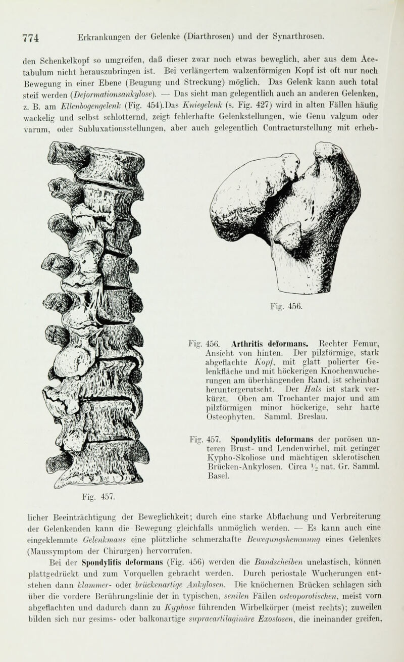 den Schenkel köpf so umgreifen, daß dieser zwar nocli etwas beweglich, aber aus dem Ace- tabulum nicht herauszubringen ist. Bei verlängertem walzenförmigen Kopf ist oft nur noch Bewegung in einer Ebene (Beugung und Streckung) möglich. Das Gelenk kann auch total steif werden {DejormaHonsankylose). — Das sieht man gelegentlich auch an anderen Gelenken, z. B. am EHenhogengelenk (Fig. 454).Das Kniegelenk (s. Fig. 427) wird in alten Fällen häufig wackeli und selbst schlotternd, zeigt fehlerhafte Gelenkstellungen, wie Genu valgum oder varum, oder Subluxationsstellungen, aber auch gelegentlich Contracturstellung mit erlieb- Fie. 456. Fig. 456. Arthritis deforinans. Rechter Femur, Ansicht von hinten. Der pilzförmige, stark abgeflaclite Kopf, mit glatt polierter Ge- lenkfläche und mit höckerigen Knochenwuche- rungen am überliängenden Rand, ist scheinbar heruntergerutscht. Der Hals ist stark ver- kürzt. Oben am Troehanter major und am pilzförmigen minor höckerige, sehr harte Osteophyteii. Samml. Breslau. Fig. 457. Spondylitis deformans der porösen un- teren Brust- und Lendenwirbel, mit geringer Iv}'pho-Skoliose und mächtigen sklerotischen Brücken-Ankylosen. Circa ' '■, nat. Gr. Samml. Basel. l-'ie. 457. lieber Beeinträchtigung der Beweglichkeit; durcli euie. starke Abflachung und Verbreiterung der Gelenkenden kann die Bewegimg gleichfalls unmöglicli werden. — Es kann auch eine eingeklemmte Gelenlmaiis eine plötzliche schmerzliafte Bewegmigshemmung eines Gelenkes (Maussymjitom der Clürurgen) hervorraien. Bei der Spondylitis deformans (Fig. 456) werden die Bandsclieiben unelastisch, können plattgedrückt und zum Vorciuellen gebracht werden. Durch periostale Wucherungen ent- stehen dann Hammer- oder brückenariige Ankylose^i. Die knöchernen Brücken schlagen sich über die vordere Berührungslinie der in typischen, senilen Fällen osieoporotischen, meist vorn abgeflachten und dadurch dann zu Kyphose führenden Wirbelkörper (meist rechts); zuweilen bilden sicli nur gesims- oder balkonartige stipracarfihigiiiiire Exostosen, die ineinander greifen,