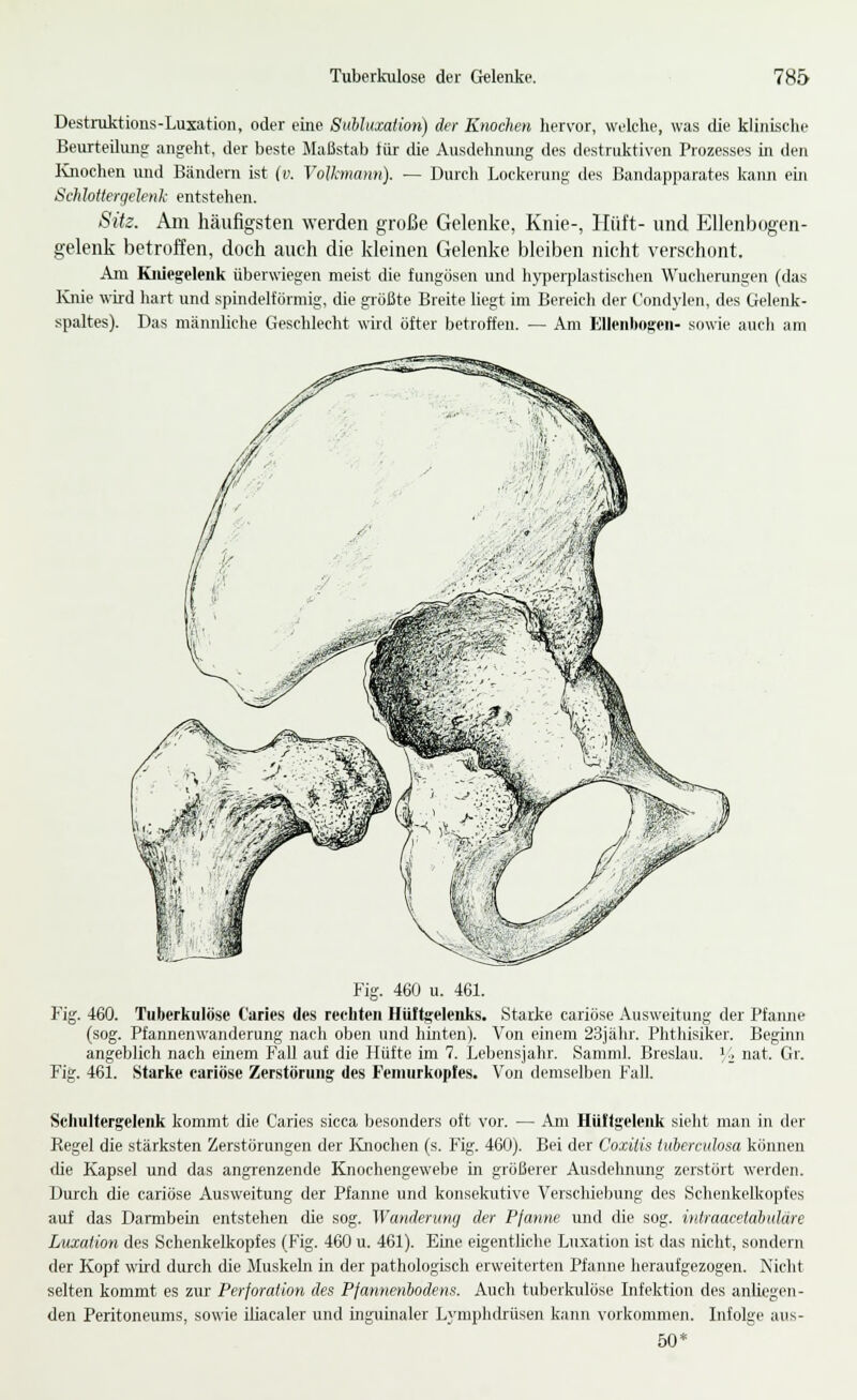 Destniktions-Luxation, oder eiiie Subluxation) der Knochen hervor, welche, was die klinische Beurteilung angeht, der beste Maßstab tür die Ausdehnung des destruktiven Prozesses in den Ivnochen und Bändern ist (v. Volkmann). — Durch Lockerung des Bandapparates kann ein Schlotiergelenk entstehen. Sitz. Am häufigsten werden große Gelenke, Knie-, Hüft- und Ellenbogen- gelenk betroffen, doch auch die kleinen Gelenke bleiben nicht verschont. Ain Kniegelenk überwiegen meist die fungösen untl hyperplastischen Wucherungen (das Ivnie wird hart und spindelförmig, die größte Breite liegt im Bereich der Condylen, des Gelenk- spaltes). Das männliche Geschlecht wird öfter betroffen. — Am Ellenbogen- sowie auch am Fig. 460 u. 461. Fig. 460. Tuberkulöse Caries des recbten Hiiltgelenks. Starke cariöse Ausweitung der Pfanne (sog. Pfannenwanderung nach oben und hinten). Von einem 23iähr. Phthisiker. Beginn angeblich nach einem Fall auf die Hüfte im 7. Lebensjahr. Samml. Breslau. ]■, nat. Gr. Fig. 461. Starke cariöse Zerstörung des Feniurkopfes. Von demselben Fall. Scliultergelenk kommt die Caries sicca besonders oft vor. — Am Hüllgeleiik sieht man in der Regel die stärksten Zerstörungen der Ivnochen (s. Rg. 460). Bei der Coxitis tuherculosa köimen die Kapsel und das angrenzende Knochengewebe in größerer Ausdehnung zerstört werden. Durch die cariöse Ausweitung der Pfanne und konsekutive Verschiebung des Schenkelkopfes auf das Darmbein entstehen die sog. Wanderung der Pfanne und die sog. iniraacetahidäre Luxaiioti des Schenkelkopfes (Fig. 460 u. 461). Eine eigentliche Luxation ist das nicht, sondern der Kopf wird durch die Muskeln in der pathologisch erweiterten Pfanne heraufgezogen. Nicht selten kommt es zur Perforation des Pfannenhodens. Auch tuberkulöse Infektion des anliegen- den Peritoneums, sowie iüacaler und inguinaler Lymphdrüsen kann vorkommen. Infolge aus- ÖO*
