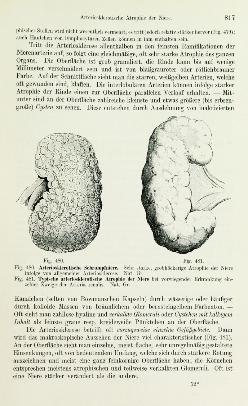 phischer Stellen wird nicht wesentlich vermehrt, es tritt jedoch relativ stäiker hervor (Fig. 479); auch Häufchen von lymphocytären Zellen können in ihm enthalten sein. Tritt die Arterioslderose allenthalben in den feinsten Ramifikationen der Merenarterie anf, so folgt eine gleichmäßige, oft sehr starke Atrophie des ganzen Organs. Die Oberfläche ist grob granuliert, die Rinde kann bis auf wenige Millimeter verschmälert sein und ist von blaßgrauroter oder rötlichbrauner Farbe. Auf der Schnittfläche sieht man die starren, weißgelben Arterien, welche oft gewunden sind, klaffen. Die interlobulären Arterien können infolge starker Atrophie der Rinde einen zur Oberfläche parallelen Verlauf erhalten. — Mit- unter sind an der Oberfläche zalüi'eiche kleinste und etwas größere (bis erbsen- große) Cysten zu sehen. Diese entstehen durch Ausdehnung von inaktivierten Fig. 480. Fig. 481. Fig. 480. Arteriosklerotische Seliriiiiipliniere. Sehr starke, grobhöckerige Atrophie der Xiere infolge von allgemeiner Arteriosklerose. Xat. Gr. Fig. 481. Typische arteriosklerotisclie .4trophie der Niere bei vorwiegender Erkrankung ein- zelner Zweige der Arteria renalis. Nat. Gr. Kanälchen (selten von Bowmanschen Kapseln) durch wässerige oder häufiger durch kolloide Massen von bräunlichem oder bernsteingelbem Farbenton. — Oft sieht man zahllose hyaline und verhilkte Glomeruli oder Cystchen mit kalkigem Inhalt als feinste graue resp. kTeideweiße Pünktchen an der Oberfläche. Die Arteriosklerose betrifft oft vorzugsweise einzelne Gefäßgebiete. Dann wird das makroskopische Aussehen der Niere viel charakteristischer (Fig. 481). An der Oberfläche sieht man einzelne, meist flache, sehr' unregelmäßig gestaltete Einsenkungen, oft von bedeutendem Umfang, welche sich durch stärkere Rötung auszeichnen und meist eine ganz feinkörnige Oberfläche haben; die Körnchen entsprechen meistens atrophischen und teilweise verkallvten Glomeruli. Oft ist eine Niere stärker verändert als die andere. 62»