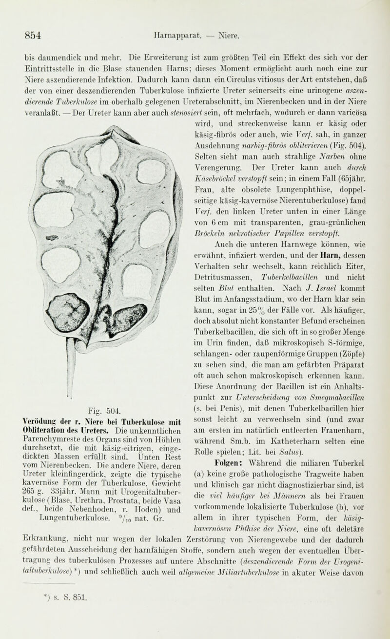 bis daumendiclv viiul mehr. Die Erweiterung ist zum gi'ößten Teil ein Effelvt des sicli vor der Eintrittsstelle in die Blase stauenden Harns; dieses Moment ermöglicht auch noch eine zur Niere aszendierende Inf ektion. Dadurch kann dann ein Circulusvitiosus der Art entstehen, daß der von einer deszendierenden Tuberkulose infizierte Ureter seinerseits eine urinogene aszen- dierende Tuherhdose im oberhalb gelegenen Ureterabschnitt, im Nierenbecken und in der Niere veranlaßt. — Der Ureter kann aber auch sfenosiert sein, oft mehrfach, wodurch er dann varicösa -^ wird, und streckenweise kann er käsig oder käsig-fibrös oder auch, wie Verf. sah, in ganzer Ausdehnung narbig-fibrös obliterieren (Fig. 504). Selten sieht man auch strahlige Narben ohne Verengerung. Der Ureter kann auch durch Kasebröckel verstopft sein; in einem Fall (65jähr. Frau, alte obsolete Lungenphthise, doppel- seitige käsig-kavernöse Nierentuberkulose) fand Verf. den linken Ureter unten in einer Länge von 6 cm mit transparenten, grau-grünlichen Bröckeln nekrotischer Papillen verstopft. Auch die unteren Harnwege können, wie erwähnt, infiziert werden, und der Harn, dessen Verhalten sehr wechselt, kann reichlich Eiter, Detritusmassen, TuherkelbaciUen und nicht selten Blut enthalten. Nach J. Israel kommt Blut im Anfangsstadium, wo der Harn klar sein kann, sogar in 2b„ der Fälle vor. Als häufiger, doch aljsolut nicht konstanter Befund erscheinen Tuberkelbacillen, die sich oft in so großer Menge im Urin finden, daß mikroskopisch S-förmige, schlangen- oder raupenförmige Gnippen (Zöpfe) zu sehen sind, die man am gefärbten Präparat oft auch schon makroskopisch erkennen kann. Diese Anordnung der Bacillen ist ein Anhalts- punkt zur Unterscheidung von Smegmabacillen (s. bei Penis), mit denen TuberkelbacUlen hier sonst leiclit zu verwechseln sind (und zwar am ersten im natürlich entleerten F'rauenharn, während Sm.b. im Katheterharn selten eine Rolle spielen; Lit. bei Salus). Folgen: Während die miharen Tuberkel (a) keine große pathologische Tragweite haben und khnisch gar nicht diagnostizierbar sind, ist die viel hüußger bei Mämiern als bei F'rauen vorkommende lokaUsierte Tuberkulose (b), vor allem in ihrer tj-pischen Form, der küsig- kavernösen Phthise der Niere, eine oft deletäre Erkrankuug, niclit nur wegen der lokalen Zerstönmg von Nierengewebe und der dadurch gefährdeten Ausscheidung der harnfähigen Stoffe, sondern auch wegen der eventuellen lljer- tragung des tuberkulösen Prozesses auf untere Abschnitte (deszendierende Form der Urogeni- taltuberkulose} *) und schheßUch auch weil allgemeine Miliartuberkulose in akuter Weise davon Fig. 504. Verödiuig der r. Niere bei Tuberkulose mit Obliferation des Ureters. Die unkenntlichen Parenchymreste des Organs sind von Hohlen durchsetzt, die mit käsig-eitrigen, einge- dickten Massen erfüllt sind. Unten Rest vom Nierenbecken. Die andere Niere, deren Ureter kleinfingerdick, zeigte che typische kavernöse Form der Tuberkulose. Gewicht 265 g. 33iähr. Mann mit Urogenitaltnber- kulose (Blase. Urethra, Prostata, beide Vasa def., beide Nebenhoden, r. Hoden) und Lungentuberkulose, '/lo nat. Gr. ') s. S. 851.