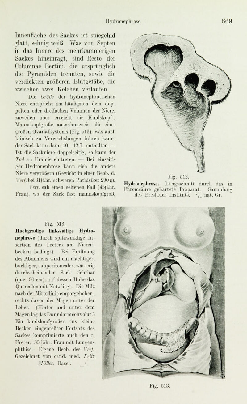 Hydroiu'phrose. «Ü9 Innenfläche des Sackes ist spiegelnd glatt, sehnig \Yeiß. Was von Septen in das Innere des mehrkamnierigen Sackes hineinragt, sind Reste der Columnae Bertini, die ursprünglich die Pyramiden trennten, suwie die verdickten größeren Blutgefäße, die zwischen zwei Kelchen verlaufen. Die (Iröße der hydroiiepluotischen Niere entspricht am häufigsten dem dop- pelten oder dreifachen Volumen der Niere, zuweilen aber erreicht sie Kindskopf-, !Mannskopfgroße, ausnahmsweise die eines großen Ovarialkystoms (Fig. 513), was aucli kUnisch zu Verwechslungen Jüliren kann: der Sack kann dann 10—12 L. enthalten. — Ist die Sackniere doppelseitig, so kann der Tod an Urämie eintreten. — Bei einseiti- ger Hydronephrose kann sich die andere Niere vergrößern (Gewicht in einer Beob. d. Verf. beiSljähr. schweren Phthisiker 290 g). Verf. sah einen seltenen Fall (46iähr. Frau), wo der Sack fast mannskopfgToß, Fig. 512. Hydroiieplirose. Längsschnitt chircli das in (.'hromsäure gehärtete Präparat. Sammlung des Breslauer Instituts, ^j, nat. (ir. Fig. 513. Hochgradige linksseitige Hydro- nephrose (durch spitzwinkhge In- sertion des Ureters am Nieren- becken bedingt). Bei Eröffnung des Abdomens wird ein mächtiger, buckhger, subperitonealer, wässerig durchscheinender Sack sichtbar (quer 30 cm), auf dessen Höhe das Quercolon mit Netz hegt. Die Milz nach der MitteUinie emporgehoben; rechts davon der klagen unter der Leber. (Hinter und unter dem Magen lag das Dünndarmconvolut.) Ein kindskopfgroßer, ins kleiiu' Becken eingepreßter Fortsatz des Sackes komprimierte auch den r. Ureter. 33 jähr. Frau mit Lungen- phthise. Eigene Beob. des Ter/- Gezeichnet von cand. med. Frits Muller, Basel. Fig. 613.