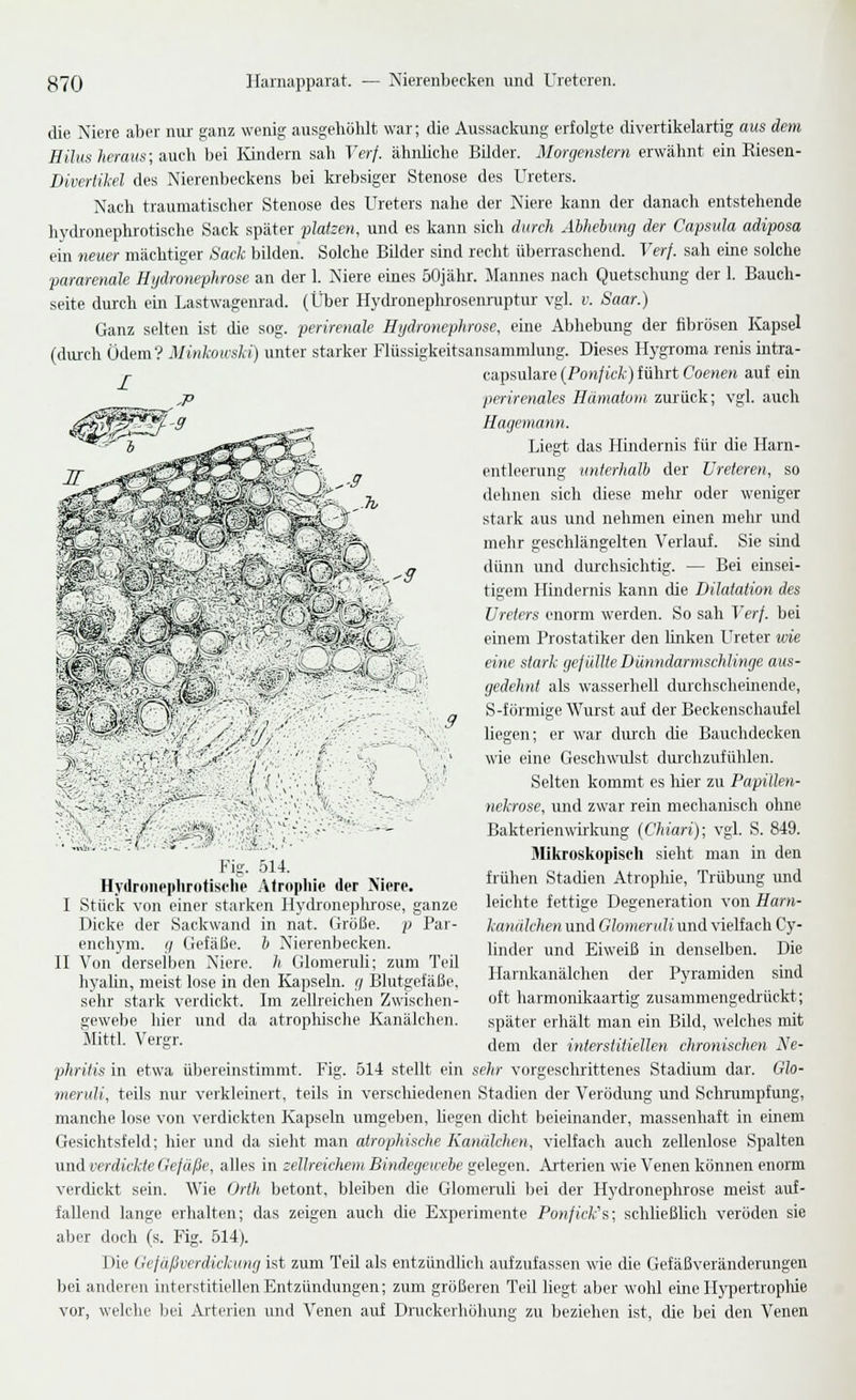 die Niere aber nur ganz wenig ausgehöhlt war; die Aussackung erfolgte divertikelartig ans dem Hiltis heraus; d^ndi bei Kindern sah Verf. ähnliche Bilder. Morgenstern erwähnt ein Riesen- Divertikel des Nierenbeckens bei krebsiger Stenose des Ureters. Nach traumatischer Stenose des Ureters nahe der Niere kann der danach entstehende hvilronephrotische Sack später platzen, und es kann sich durch Abhebung der Capsula adiposa ein neuer mächtiger Sack bilden. Solche Bilder sind recht überraschend. Verf. sah eine solche 'pararenale Hgclronephrose an der 1. Niere eines öOjähr. Jlannes nach Quetschung der 1. Bauch- seite durch ein Lastwagenrad. (Über Hydronephrosenruptur vgl. v. Saar.) Ganz selten ist die sog. perirenale Hydronephrose, eine Abhebung der fibrösen Kapsel (durch Ödem? MMousli) unter starker Flüssigkeitsansammlung. Dieses Hygroma renis intra- capsulare {Ponjick) führt Coenen auf ein perirenales Hämatom zurück; vgl. auch Hagemann. Liegt das Hindernis für die Harn- entleerung imterhalb der Ureteren, so dehnen sich diese mehr oder weniger stark aus und nehmen einen mehr und mehr geschlängelten Verlauf. Sie sind dünn und durchsichtig. — Bei einsei- tigem Hindernis kann die Dilatation des Ureters enorm werden. So sah Verf. bei einem Prostatiker den linken Ureter ude eitle stark gejüllie Dünndarmschlinge aus- gedehnt als wasserhell durchscheinende, S-förmige Wurst auf der Beckenschaufel liegen; er war durch che Bauchdecken wie eine Geschwulst dmxhzufühlen. Selten kommt es hier zu Papillen- nekrose, und zwar rein mechanisch ohne Bakterien\virkung (Chiari); vgl. S. 849. Mikroskopisch sieht man in den frühen Stadien Atrophie, Trübung und leiclite fettige Degeneration von Harn- kanulchen und Glomeruli und vielfach Cy- linder und Eiweiß in denselben. Die Harnkanälchen der Pyramiden sind oft harmonikaartig zusammengedi'ückt; später erhält man ein Bild, welches mit dem der interstitiellen chronischen Ne- phritis in etwa übereinstimmt. Fig. 514 stellt ein sehr vorgeschrittenes Stadium dar. Glo- meruli, teils nur verkleinert, teils in verschiedenen Stadien der Verödung und Schnimpfung, manche lose von verdickten Kapseln umgeben, liegen dicht beieinander, massenhaft in einem Gesichtsfeld; hier und da sieht man atrophische Kanälchen, vielfach auch zellenlose Spalten vind verdickte Gefäße, alles in zellreichem Bindegewebe gelegen. Arterien wie Venen können enoim verdickt sein. Wie Orth betont, bleiben die Glomeruli bei der Hydronephrose meist aivf- fallend lange erhalten; das zeigen auch die Experimente Ponfick's; schließlich veröden sie aber doch (s. Fig. 514). Die Gejäßverdickung ist zum Teil als entzündlich aufzufassen wie cUe Gefäßveränderungen bei anderen interstitiellen Entzündungen; zum größeren Teil liegt aber wohl eine Hj'pertropMe vor, welche bei Arterien und Venen anf Druckerhühung zu beziehen ist, die bei den Venen II lg j14 Hydronephrotisi'lie .\tropliie der Xiero. Stück von einer starken Hydroneplrrose, ganze Dicke der Sackwand in nat. Größe, p Par- enchym. g Gefäße, b Nierenbecken. Von derselben Niere, h Glomeruli; zum Teil hyaUn, meist lose in den Kapseln, g Blutgefäße, sehr stark verdickt. Im zellreichen Zwischen- gewebe hier und da atrophische Kanälchen. Mittl. Vergr.