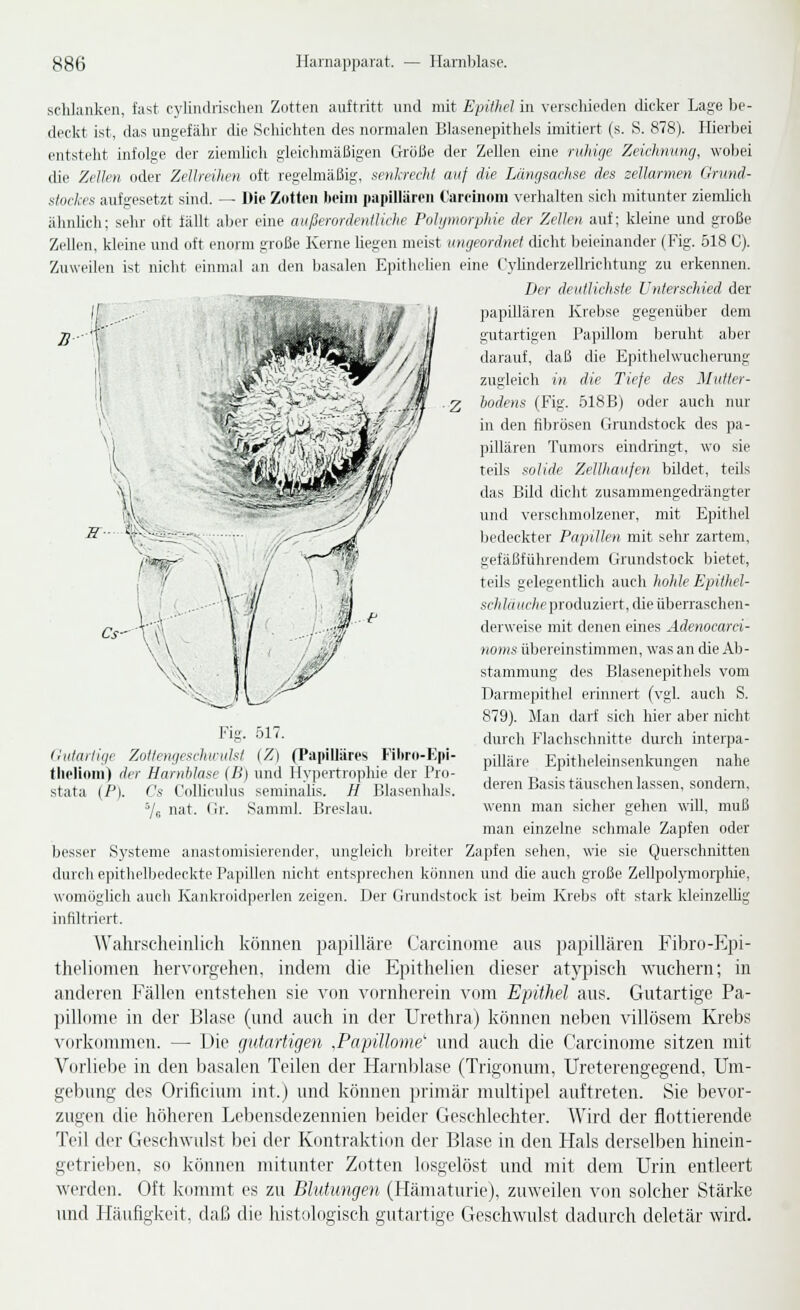 schlanken, fast cylindrisclien Zotten auftritt nnd mit Epithel in verschieden dicker Lage be- deckt ist, das ungefähr die Schichten des normalen Blasenepithels imitiert (s. S. 878). Hierbei entsteht infolge der ziemhch gleichmäßigen Größe der Zellen eine ruhige Zeichmmg, wobei die Zellen oder Zellreihen oft regelmäßig, senkrecht auf die Längsachse des zellarmen Grund- stockes aufgesetzt sind. — Die Zotten beim papillären Caroinom verhalten sich mitunter ziemhch ähnhch; sehr oft fällt al)ei- eine außerordentliche Polymorphie der Zellen auf; kleine und große Zellen, kleine und oft enorm große Kerne hegen meist ungeordnet chcht l)eieinander (Fig. 518 C). Zuweilen ist nicht einmal an den basalen Epithclien eine Cyhnderzellrichtung zu erkennen. Der deutlichste Unterschied der 'I papillären Krebse gegenüber dem gutartigen Papillom beruht aber darauf, daß die Epithelwuchemng zugleich in die Tiefe des Mutter- hodens (Fig. 518B) oder auch nur in den filjrösen Grundstock des pa- pillären Tumors eindringt, wo sie teils solide Zellhaufen bildet, teils das Bild dicht zusammengedrängter und verschmolzener, mit Epithel bedeckter Papillen mit sehr zartem, gefäßführendem Grundstock bietet, teils gelegenthch auch hohle Epitlwl- sc/ifo(i(f/ie produziert, die überraschen- derweise mit denen eines Ädenocarci- noms übereinstimmen, was an che Ab- stammung des Blasenepithels vom Darmepithel erinnert (vgl. auch S. 879). Man darf sich hier aber nicht durch F'lachschnitte durch interpa- pilläre Epitheleinsenkungen nahe deren Basis täuschen lassen, sondem. wenn man sicher gehen will, muß man einzelne sclimale Zapfen oder besser S3'steme anastomisierender, ungleicli Ijreiter Zapfen sehen, wie sie Querschnitten durch e])ithelbedeckte Papillen nicht entsprechen können und che auch große Zellpolymorpliie, womöglich auch Kankroidperlen zeigen. Der Grundstock ist beim Krebs oft stark kleinzeUig infiltriert. Wahrscheinlich küimcii papilläre Carciiiume aus papillären Fibro-Epi- theliomen hervorgehen, indem die Epithelien dieser atypisch wuchern; in anderen Fällen entstehen sie von vornlierein vom Epithel aus. Gutartige Pa- pillome in der Blase (und auch in der Urethra) können neben villösem Krebs vorkommen. —■ Die gutartigen .Papillome und auch die f'arcinome sitzen mit Vorliebe in den basalen Teilen der Harnblase (Trigonum, Ureterengegend, Um- gebung des Orificium int.) und können primär multipel auftreten. Sie bevor- zugen die höheren Lebensdezennien beider Geschlechter. Wird der flottierende Teil der Geschwulst bei der Kontraktion der Blase in den Hals derselben hinein- getrieben, so können mitunter Zotten losgelöst und mit dem Urin entleert werden. Oft kommt es zu Blutungen (Hämaturie), zuweilen von solcher Stärke und Häufigkeit, daß die histologisch gutartige Geschwulst dadurch deletär wird. (hitartifie Fig. Zotleniieschiriilsl 517. iZ] (Papilläres Filtro-Kpi- tholinm) lier Harnblase (B) und Hypertrophie der Pro- stata (P). Cs Colliculus seminalis. H Bhisenlials. ^6 nat. Gr. Samml. Breslau.