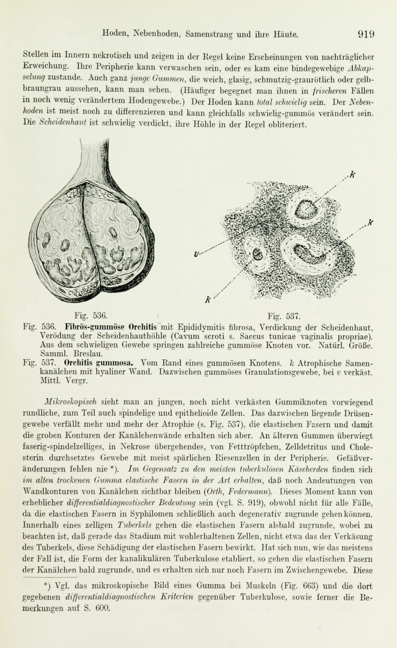 Stellen im Innern neki-otisch und zeigen in der Regel keine Erscheinungen von naeliträgUcher Erweichung. Ihre Peripherie kann verwasclien sein, oder es kam eme bmdegewebige Abkap- selung zustande. Auch ganz junge Gummen, die weich, glasig, schmutzig-gramötUcli oder gelb- braungrau ausseliei), kann man sehen. (Häufiger begegnet man ihnen in frischeren FäUen in noch wenig verändertem Hodengewebe.) Der Hoden kann total schwielig sein. Der Nebm- hoden ist meist noch zu differenzieren und kann gleiclifalls schwehg-gunmiös verändert sein. Die Scheidenhaut ist schwielig verdickt, ilue Hülile in der Regel obliteriert. Fig. 536. Fig. 537. Fig. 536. Fibrös-giinimöse Orcliitis^mit Epididymitis fibrosa, Verdickung der Scheidenhaut, Verödung der Scheidenhauthöhle (Cavum scroti s. Saccus tunicae vaginahs propriae). Aus dem schwieligen Gewebe springen zahlreiche gummöse Knoten vor. Natürl. Größe. Samml. Breslau. Fig. 537. Orchitis gummosa. Vom Rand eines gummösen Ivnotens. k Atrophische Samen- kanälchen mit hyaliner Wand. Dazwischen gummöses Granulationsgewebe, bei v verkäst. Mittl. Vergr. Mikroskopisch sieht man an jungen, noch nicht verkästen Gummiknoten vonriegend rundliche, zum Teil auch spindelige und epithelioide Zellen. Das dazwischen hegende Drüsen- gewebe verfällt mehr und mehr der Atroplüe (s. Fig. 537), die elastischen Fasern und damit die groben Konturen der Kanälchenwände erhalten sich aber. An älteren Gummen überwiegt faserig-spindelzeUiges, in Nekrose übergehendes, von Fetttrüpfchen, Zelldetritus und Chole- sterin durchsetztes Gewebe mit meist spärKchen Riesenzellen in der Peripherie. Gefäßver- änderungen fehlen nie *). /m Gegensatz zu den meisten tuberkulösen Käseherden finden sich im alten trockenen Gumma elastische Fasern in der Art erhalten, daß noch Andeutungen von Wandkonturen von Kanälchen sichtbar bleiben (firth, Federmann). Dieses Jloment kann von erhebhcher diflerentialdiagnostischer Bedeutung sein (vgl. S. 919), obwohl nicht für alle Fälle, da che elastischen Fasern in SyiJhilomen schbeßUch auch degenerativ zugnmde gehen können. Innerhalb eines zelligen Tuberkels gehen die elastischen Fasern alsbald zugrunde, wobei zu beachten ist, daß gerade das Stadium mit wohlerhaltenen Zellen, nicht etwa das der Verkäsimg des Tuberkels, diese Schädigung der elastischen Fasern bewirkt. Hat sich nun, wie das meistens der Fall ist, die Form der kanalikulären Tuberkulose etabliert, so gelien die elastischen Fasern der Kanälchen bald zugrunde, und es erhalten sich nur noch Fasern im Zwischengewebe. Diese *) Vgl. das mikroskopische Bild eines Gumma bei Jluskehi (Fig. 663) und die dort gegebenen differentialdiagnostischen Kriterien gegenüber Tuberlailose, sowie ferner die Be- merkungen auf S. 600.
