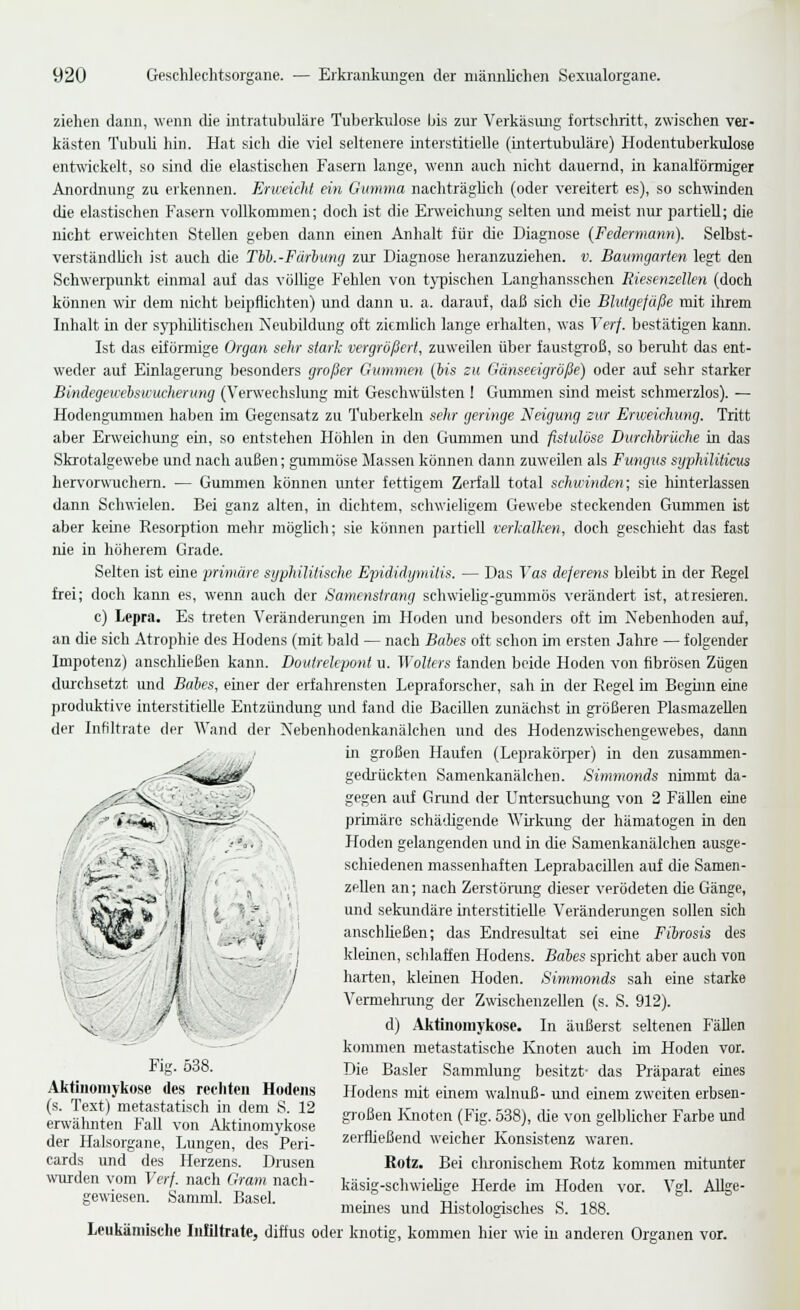 ziehen dann, wenn die intratubuläre Tuberkulose Ijis zur Verkäsiuig fortschritt, zwischen ver- kästen Tubuli hin. Hat sich die viel seltenere interstitielle (intertubidäre) Hodentuberkulose entwickelt, so sind die elastischen Fasern lange, wenn auch nicht dauernd, in kanalfönniger Anordnung zu erkennen. Erweicht ein Gumma nachträgUch (oder vereitert es), so schwinden die elastischen Fasern vollkommen; doch ist die Erweichung selten und meist nur partiell; die nicht erweichten Stellen geben dann einen Anhalt für die Diagnose (Fedennann). Selbst- verständüch ist auch die Tbh.-Fdrhtmg zur Diagnose heranzuziehen, v. Baimgarten legt den Schwerpunkt einmal auf das völhge Fehlen von typischen Langhansschen Riesenzellen (doch können wir dem nicht beipflichten) und dann u. a. darauf, daß sich die Blutgefäße mit ilirem Inhalt in der syphilitischen Neubildung oft ziemlich lange erhalten, was Verf. bestätigen kann. Ist das eiförmige Organ sehr stark vergrößert, zuweilen über faustgroß, so beruht das ent- weder auf Einlagenmg besonders großer Gummen {iis zu Gänseeigröße) oder auf sehr starker Binäegeuehsuucherung (Verwechslung mit Geschwülsten ! Gummen sind meist schmerzlos). — Hodengiunmen haben im Gegensatz zu Tuberkebi sehr geringe Neigung zur Erweichung. Tritt aber Erweichung ein, so entstehen Höhlen in den Gununen und fistulöse Durchbrüche in das Skrotalgewebe und nach außen; gummöse Massen können dann zuweilen als Fungus syphiliticus hervorwuchem. — Gunmien können unter fettigem Zerfall total schwinden; sie hinterlassen dann Schwielen. Bei ganz alten, in dichtem, schwieligem Gewebe steckenden Gummen ist aber keine Resoi-ption mehr möglich; sie können partiell verkalTcen, doch geschieht das fast nie in höherem Grade. Selten ist eine primäre syphilitische Epididymitis. — Das Vas deferens bleibt in der Regel frei; doch kann es, wenn auch der Samenstrang schwiebg-gummös verändert ist, atresieren. c) Lepra. Es treten Verändenmgen im Hoden und besonders oft im Nebenhoden auf, an die sich Atrophie des Hodens (mit bald — nach Babes oft schon im ersten Jahre — folgender Impotenz) anschheßen kann. Doutrelepont u. Wolters fanden beide Hoden von fibrösen Zügen durchsetzt und Babes, einer der erfahrensten Lepraforscher, sah in der Regel im Begüm eine produktive interstitielle Entzündung und fand die Bacillen zunächst in größeren PlasmazeUen der Infiltrate der Wand der Nebenhodenkanälchen und des Hodenzwischengewebes, daim in großen Haufen (Leprakörper) in den zusammen- gedrückten Samenkanälchen. Simmonds nimmt da- gegen auf Grund der Uirtersuchung von 2 Fällen eine prünäro schädigende Wirkung der hämatogen in den Hoden gelangenden und in die Samenkanälchen ausge- schiedenen massenhaften Leprabacillen auf die Samen- zellen an; nach Zerstörang dieser verödeten die Gänge, und sekundäre interstitielle Veränderungen sollen sich anschheßen; das Endresultat sei eine Fibrosis des kleinen, schlaffen Hodens. Babes spricht aber auch von harten, kleinen Hoden. Simmonds sah eine starke Vermehi-ung der Zwischenzellen (s. S. 912). d) Aktlnomykose. In äußerst seltenen Fällen kommen metastatische Knoten auch im Hoden vor. Die Basler Sammlung besitzt- das Präparat eines Hodens mit einem walnuß- und einem zweiten erbsen- großen Ivnotcn (Fig. 538), die von gelblicher Farbe und zerfließend weicher Konsistenz waren. Rotz, Bei clrronischem Rotz kommen mitunter käsig-schwiehge Herde im Hoden vor. Vgl. Allge- meines und Histologisches S. 188. Leukämische IiiBltrate, diffus oder knotig, kommen hier wie in anderen Organen vor. / Fig. 538. Aktiiiomykose des rechten Hodens (s. Text) metastatisch in dem S. 12 erwäluiten Fall von Aktlnomykose der Halsorgane, Lungen, des Peri- cards und des Herzens. Diusen wirrden vom Verf. nach Gram nach- gewiesen. Samml. Basel.