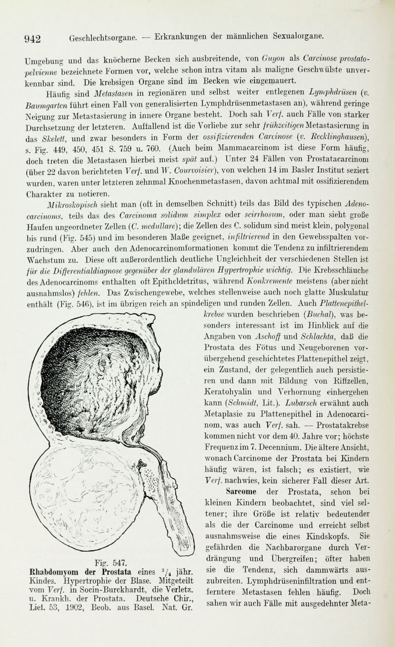 Um^ebunff und das knöcherne Becken sich ausbreitende, von Guijon als Carcinose prostato- pelvienne bezeichnete Formen vor, welche schon intra vitani als maligne Geschwülste unver- kennbar sind. Die krebsigen Organe sind im Becken wie eingeinauert. Häufig sind Metastasen in regionären und selbst weiter entlegenen Lymphdrüsen {v. Baumgarten fülut einen Fall von generalisierten LjTiiphdrüsenmetastasen an), während geringe Neinmg zur Metastasierung in innere Organe besteht. Doch sah Verf. auch Fälle von starker Durchsetzung der letzteren. Auüallend ist die Vorliebe zur sehr frühzeitigen Metastasierung in das Skelett, und zwar besonders in Form der ossifizierenden Carcinose (v. Recliinghausen), s. Fi. 449, 460, 4B1 S. 759 u. 760. (Auch beim Mamraacarcinom ist diese Form häufig, doch treten die Metastasen liierbei meist spät auf.) Unter 24 Fällen von Prostatacarcinom (über 22 davon berichteten Verf. und W. Courvoisier), von welchen 14 im Basler Institut seziert wurden, waren unter letzteren zehnmal Knochenmetastasen, davon achtmal mit ossifizierendem Charakter zu notieren. Mikroskopiseh sieht man (oft in demselben Schnitt) teils das Bild des tj'pischen Adem- carcinoms, teUs das des Carcinoma solidum simplex oder scirrhosum, oder man sieht gToße Haufen ungeordneter Zellen (C. medulläre); die Zellen des C. solidum sind meist klein, polygonal bis rund (Fig. 545) und im besonderen Maße geeignet, infltrierend in den Gewebsspalten vor- zudringen. Aber auch den Adenocarcinomformationen kommt die Tendenz zu infiltiierendem Wachstum zu. Diese oft außerordentlich deutliche Ungleichheit der verschiedenen Stellen ist für die Diflerentialdiagnose gegenüber der glandulären Hypertrophie tvichtig. Die Krebsschläuche des Adenocarchioms enthalten oft Epitheldetritus, während Konkremente meistens (aber nicht ausnahmslos) fehlen. Das Zwischengew'ebe, welches stellenweise auch noch glatte Muskulatur- enthält (Fig. 54fi), ist im übrigen reich an spindeligen und randen Zellen. Auch Plattenepithel- krehse wurden besclirieben (Biichal). was be- sonders iirteressant ist im Hinblick auf tue Angaben von Aschoff und Schlachta, daß die Prostata des Fötus luid Neugeborenen vor- übergehend geschichtetes Plattenepithel zeigt, ein Zustand, der gelegenthch auch persistie- ren und dann mit Bildung von KiffzeUen, KeratohyaMn und Verhomung ernhergehen kann (Schmidt, Lit.). Lubarsch erwälmt auch Metaplasie zu Plattenepithel in Adenocarci- nom, was auch Yerf. sah. — Prostatakrebse kommen nicht vor dem 40. Jahr-e vor; höchste Frequenz im 7. Decennium. Die ältere Ansicht, wonach Carcinome der Prostata bei Kindern häufig wären, ist falsch; es existiert, wie Verf. nachwies, kein sicherer Fall dieser Ali;. Sarcome der Prostata, schon bei kleinen Kindern beobachtet, sind viel sel- tener; ilire Größe ist relativ bedeutender als die der Carcinome und erreicht selbst ausnahmsweise die eines Kindskopfs. Sie gefährden die Nachbarorgane durch Ver- -p.^ ,,« drängung und Übergreifen; öfter haben Rhabdomyom der Prostata eines V* iäir. sie die Tendenz, sich dammwärts aus- Kindes. Hypertrophie der Blase. Mitgeteilt zubreiten. Lymphdrüseninfiltration und ent- vom Verf. in Socin-Burckhardt, die Verletz. femtere Metastasen fehlen häufig. Doch u. Krankh. der Prostata. Deutsche Chir., , . , „..,, ., j i, j. -»j- i„ Lief. 53, 1902, Beob. aus Basel. Nat. Gr. sahen w auch FaUe mit ausgedehnter Meta-