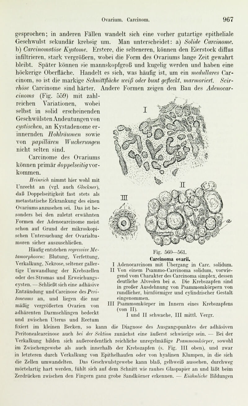 gesprochen; in anderen Fällen wandelt sich eine vorher gutartige epitheliale Geschwulst sekundär krebsig um. Man untersclieidet: a) Solide Carcinome. b) Carcinomatöse K)jstome. Erstere, die selteneren, können den Eierstock diffus infiltrieren, stark vergrößern, wobei die Form des Ovariums lange Zeit gewahrt bleibt. Später können sie mannskopfgroß und kugelig werden und haben eine höckerige Oberfläche. Handelt es sich, was häufig ist, um ein medulläres Car- cinom, so ist die markige Schnittfläche weiß oder bunt gefleckt, marmoriert. Scir- rhöse Carcinome sind härter. Andere Formen zeigen den Bau des Ädenocar- cinoms (Fig. 559) mit zahl- reichen Variationen, wobei _ ^^!^«ä.=Sss?- selbst in solid erscheinenden Geschwülsten Andeutungen von ciistischen, an Kystaden(jme er- innernden Hohlräumen sowie von papillären Wucherungen nicht selten sind. Carcinome des Ovariums können primär doppelseitig vor- kommen. Heinrich nimmt hier wohl mit Unrecht an (vgl. auch Glockner), daß Doppelseitigkeit fast stets als metastatische Erkrankung des einen Ovariums anzusehen sei. Das ist be- sonders bei den zuletzt erwähnten Formen der Adenocarcinome meist schon auf Grund der mikroskopi- schen Untersuchung der Ovarialtu- moren sicher auszuschließen. Häufig entstehen regressive Me- tamorphosen: Blutung, Verfettung, Verkalkung, Nekrose, seltener galler- tige Umwandlung der Krebszellen oder des Stromas und Erweichungs- cysten. — Schließt sich eine adhäsive Entzündung undCarcinose des Peri- toneums an, und liegen die nur mäßig vergrößerten Ovarien von adhärenten Darmschlingen bedeckt und zwischen Uterus und Rectum fixiert im kleinen Becken, so kann die Diagnose des Ausgangspunktes der adhäsiven Peritonealcarcinose auch hei der Seidion zunächst eine äußerst schwierige sein. — Bei der Verkalkung bilden sich außerordentlich reichliche unregelmäßige Psammomkörper, sowohl im Zwischengewebe als auch innerhalb der lOebszapfen (s. Fig. III oben), und zwar in letzteren durch Verkalkung von Epithelhaufen oder von hyalinen Klumpen, in die sich die Zellen umwandelten. Das Geschwulstgewebe kann blaß, gelbweiß aussehen, durchweg möiielartig hart werden, fühlt sich auf dem Schnitt wie rauhes Glaspapier an und läßt beim Zerdrücken zwischen den Fingern ganz grobe Sandkörner erkennen. — Eiähnlichc Bildungen Fig. 560—561. Carcinoma ovarü. I Adenocarcinom mit Übergang in Carc. solidum. II Von einem Psammo-Carcinoma solidum, vorwie- gend vom Charakter des Carcinoma simplex, dessen deutliche Alveolen bei a. Die Krebszapfen sLud in großer Ausdehnung von Psammomkörpern von rundlicher, bü-nförmiger und cylinchischer Gestalt eingenommen. III Psammomkörper im Innern eines Ivrebszapfens (von II). I und II schwache, III mittl. Vergr.