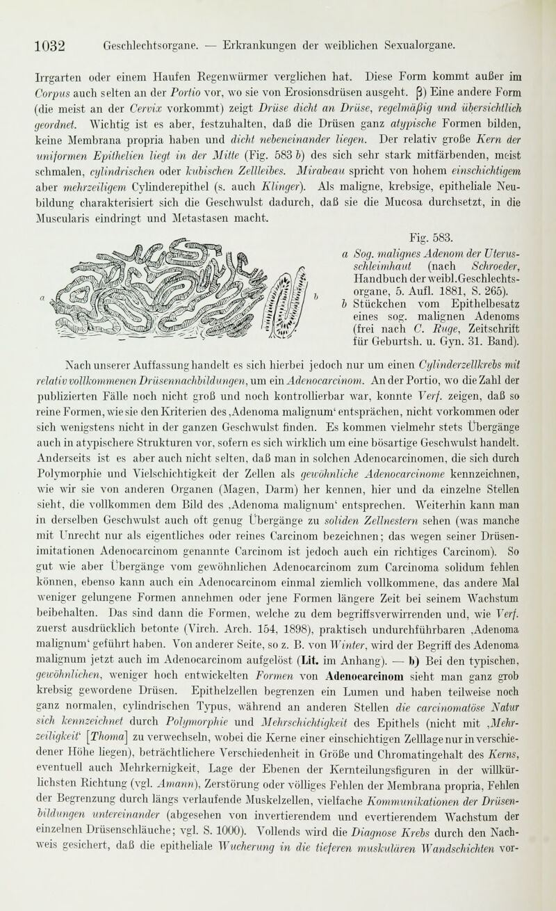 Irrgarten oder einem Haufen Regenwür-mer verglichen hat. Diese Form kommt außer im Corpus auch selten an der Portio vor, wo sie von Erosionsdr-üsen ausgeht, ß) Eine andere Form (die meist an der Cervix vorkommt) zeigt Drüse dicht an Drüse, regelmäßig und übersichtlich geordnet. Wichtig ist es aber, festzuhalten, daß die Drüsen ganz atypische Formen bilden, keine Membrana propria haben und dicht nebeneinander liegen. Der relativ große Kern der uniformen Epithelien liegt in der Mitte (Fig. 583 b) des sich sehr stark mitfärbenden, meist schmalen, eylindrischen oder kubischen Zellleibes. Mirabeau spricht von hohem einschichtigem aber mehrzeiligem Cylinderepithel (s. auch Klinger). Als mahgne, kr-ebsige, epithehale Neu- bildung charakterisiert sich die Geschwulst dadurxh, daß sie die Mucosa durchsetzt, in die Muscularis eindringt und Metastasen macht. Fig. 583. a Sog. malignes Adenom der üterus- schleimhaut (nach Schroeder, Handbuch der weibl.Geschlechts- organe, 6. Aufl. 1881, S. 265). b Stückchen vom Epithelbesatz eines sog. malignen Adenoms (frei nach C. Rüge, Zeitschrift für Geburtsh. u. Gyn. 31. Band). Nach unserer Auffassung handelt es sich hierbei jedoch nur um einen Cylinderzellkrebs mit relativvollkommenen Drüsennachbildimgen,ura ein Ädenocarcinom. An der Portio, wo die Zahl der publizierten Fälle noch nicht groß und noch kontrollierbar war, konnte Verf. zeigen, daß so reine Formen, wie sie den Kriterien des ,Adenoma malignum' entsprächen, nicht vorkommen oder sich wenigstens nicht in der ganzen Geschwulst finden. Es kommen vielmehr stets Übergänge auch in atypischere Strukturen vor, sofern es sich wirklich um eine bösartige Geschwulst handelt. Anderseits ist es aber auch nicht selten, daß man in solchen Adenocarcinomen, die sich durch Polymorphie und Vielschichtigkeit der Zellen als gewöhnliche Adenocarcinome kennzeichnen, wie wir sie von anderen Organen (Magen, Darm) her kennen, hier und da einzelne Stellen sieht, die vollkommen dem Bild des .Adenoma malignum' entsprechen. Weiterhin kann man in derselben Geschw-ulst auch oft genug Übergänge zu soliden Zellnestern sehen (was manche mit Unrecht nur als eigentliches oder reines Carcinom bezeichnen; das wegen seiner Drüsen- imitationen Ädenocarcinom genannte Carcinom ist jedoch auch ein richtiges Carcinom). So gut wie aber Übergänge vom gewöhnlichen Ädenocarcinom zum Carcinoma solidum fehlen können, ebenso kann auch ein Ädenocarcinom einmal ziemlich vollkommene, das andere Mal weniger gehmgene Formen annehmen oder jene Formen längere Zeit bei seinem Wachstum beibehalten. Das sind dann die Formen, welche zu dem begriffsverwÜTenden und, wie Verf. zuerst ausdrücklich betonte (Virch. Ai-ch. 154, 1898), praktisch undurchführbaren ,Adenoma malignum' geführt haben. Von anderer Seite, so z. B. von Winter, wird der Begriff des Adenoma malignum jetzt auch im Ädenocarcinom aufgelöst (Lit. im Anhang). — b) Bei den t)'pischen, gewöhnlichen, weniger hoch entwickelten Formen von Ädenocarcinom sieht man ganz grob krebsig gewordene Drüsen. Epithelzellen begr-enzen ein Lumen und haben teilweise noch ganz normalen, cyhndrischen Tj'pus, während an anderen Stellen die carcinomatöse Natur sich kennzeichnet durch Polymorphie und Mehrschichiigkeit des Epithels (nicht mit ,Mehr- zeiligkeit [Thoma] zu verwechseln, wobei die Kerne einer einschichtigen ZelUagenurin verschie- dener Höhe hegen), beträchtMchere Verschiedenheit in Größe und Chromatingehalt des Kerns, eventuell auch Mehrkernigkeit, Lage der Ebenen der Kernteilungsfiguren in der willkür- hchsten Richtung (vgl, Amrnm), Zerstörung oder völliges Fehlen der Membrana propria, Fehlen der Begr-enzung durch längs verlaufende Muskelzellen, vielfache Kommunikationen der Drüsen- bilclungen untereinander (abgesehen von invertierendem und evertierendem Wachstum der einzeken Drüsenschläuche; vgl. S. 1000). Vollends wird die Diagnose Krebs durch den Nach- weis gesichert, daß die epithehale Wuchenmg in die tieferen muskulären Wandschichten vor-