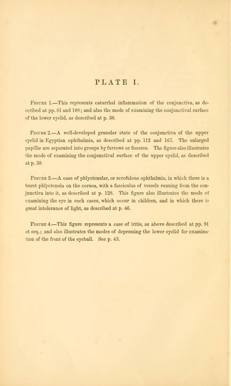 Figure 1.—This represents catarrhal inflammation of the conjunctiva, as de- scribed at pp. 81 and 108; and also the mode of examining the conjunctival surface of the lower eyelid, as described at p. 38. Figure 2.—A well-developed granular state of the conjunctiva of the upper eyelid in Egyptian ophthalmia, as described at pp. 112 and 167. The enlarged papillae are separated into groups by furrows or fissures. The figure also illustrates the mode of examining the conjunctival surface of the upper eyelid, as described at p. 38. Figure 3.—A case of phlyctenular, or scrofulous ophthalmia, in which there is a burst phlyctenula on the cornea, with a fasciculus of vessels running from the con- junctiva into it, as described at p. 128. This figure also illustrates the mode of examining the eye in such cases, which occur in children, and in which there is great intolerance of light, as described at p. 46. Figure 4.—This figure represents a case of iritis, as above described at pp. 91 et seq.; and also illustrates the modes of depressing the lower eyelid for examina- tion of the front of the eyeball. See p. 43.