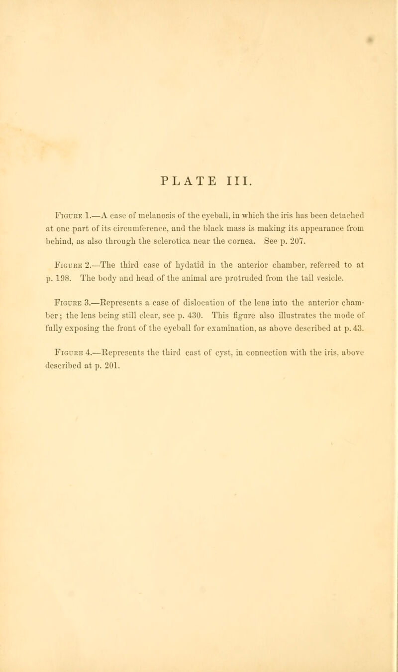 Figure 1.—A case of melanosis of the eyeball, in which the iris has been detached at one part of its circumference, and the black mass is making its appearance from behind, as also through the sclerotica near the cornea. See p. 207. Figure 2.—The third case of hydatid in the anterior chamber, referred to at p. 198. The body and head of the animal are protruded from the tail vesicle. Figure 3.—Represents a case of dislocation of the lens into the anterior cham- ber ; the lens being still clear, see p. 430. This figure also illustrates the mode of fully exposing the front of the eyeball for examination, as above described at p. 43. Figure 4.—Represents the third cast of cyst, in connection with the iris, above described at p. 201.