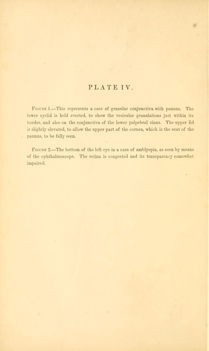 Figure 1.—This represents a case of granular conjunctiva with pannus. The lower eyelid is held everted, to show the vesicular granulations just within its border, and also on the conjunctiva of the lower palpebral sinus. The upper lid is slightly elevated, to allow the upper part of the cornea, which is the seat of the pannus, to be fully seen. Figure 2.—The bottom of the left eye in a case of amblyopia, as seen by means of the ophthalmoscope. The retina is congested and its transparency somewhat impaired.