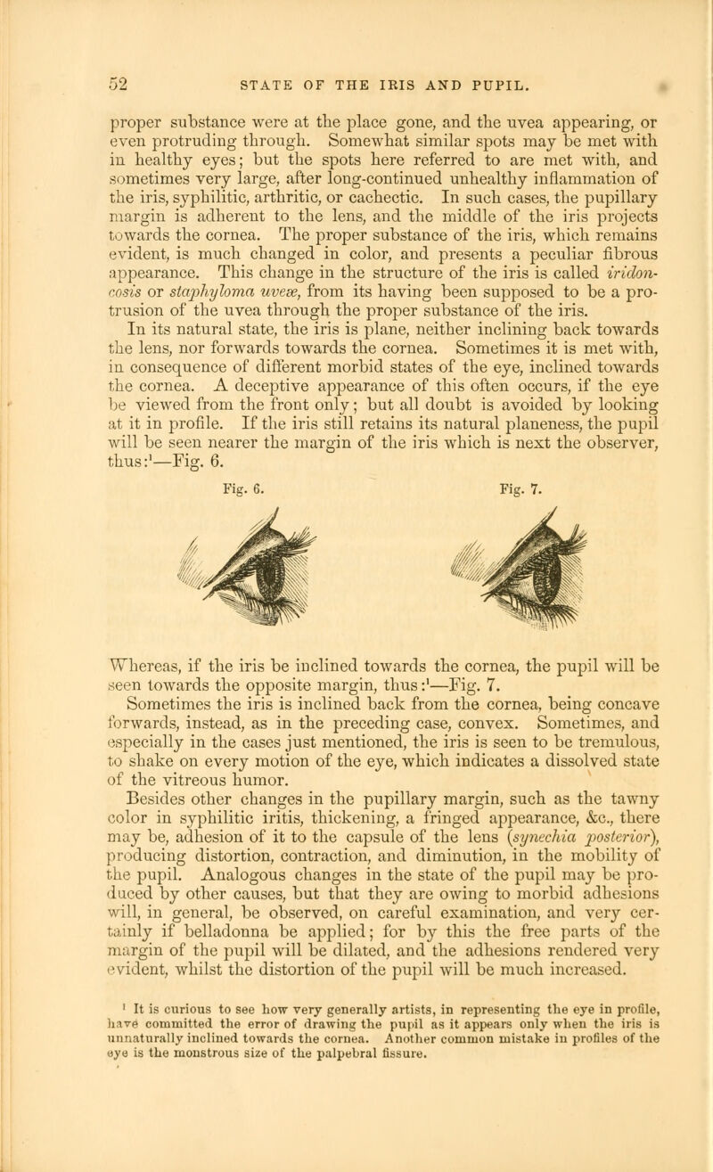 proper substance were at the place gone, and the uvea appearing, or even protruding through. Somewhat similar spots may be met with in healthy eyes; but the spots here referred to are met with, and sometimes very large, after long-continued unhealthy inflammation of the iris, syphilitic, arthritic, or cachectic. In such cases, the pupillary margin is adherent to the lens, and the middle of the iris projects towards the cornea. The proper substance of the iris, which remains evident, is much changed in color, and presents a peculiar fibrous appearance. This change in the structure of the iris is called iridon- cosis or staphyloma uvese, from its having been supposed to be a pro- trusion of the uvea through the proper substance of the iris. In its natural state, the iris is plane, neither inclining back towards the lens, nor forwards towards the cornea. Sometimes it is met with, in consequence of different morbid states of the eye, inclined towards the cornea. A deceptive appearance of this often occurs, if the eye be viewed from the front only; but all doubt is avoided by looking at it in profile. If the iris still retains its natural planeness, the pupil will be seen nearer the margin of the iris which is next the observer, thus:1—Fig. 6. Fig. 6. Fig. 7. Whereas, if the iris be inclined towards the cornea, the pupil will be seen towards the opposite margin, thus:'—Fig. 7. Sometimes the iris is inclined back from the cornea, being concave forwards, instead, as in the preceding case, convex. Sometimes, and especially in the cases just mentioned, the iris is seen to be tremulous, to shake on every motion of the eye, which indicates a dissolved state of the vitreous humor. Besides other changes in the pupillary margin, such as the tawny color in syphilitic iritis, thickening, a fringed appearance, &c, there may be, adhesion of it to the capsule of the lens (synechia posterior), producing distortion, contraction, and diminution, in the mobility of the pupil. Analogous changes in the state of the pupil may be pro- duced by other causes, but that they are owing to morbid adhesions will, in general, be observed, on careful examination, and very cer- tainly if belladonna be applied; for by this the free parts of the margin of the pupil will be dilated, and the adhesions rendered very evident, whilst the distortion of the pupil will be much increased. 1 It is curious to see how very generally artists, in representing the eye in profile, have committed the error of drawing the pupil as it appears only when the iris is unnaturally inclined towards the cornea. Another common mistake in profiles of the eye is the monstrous size of the palpebral fissure.