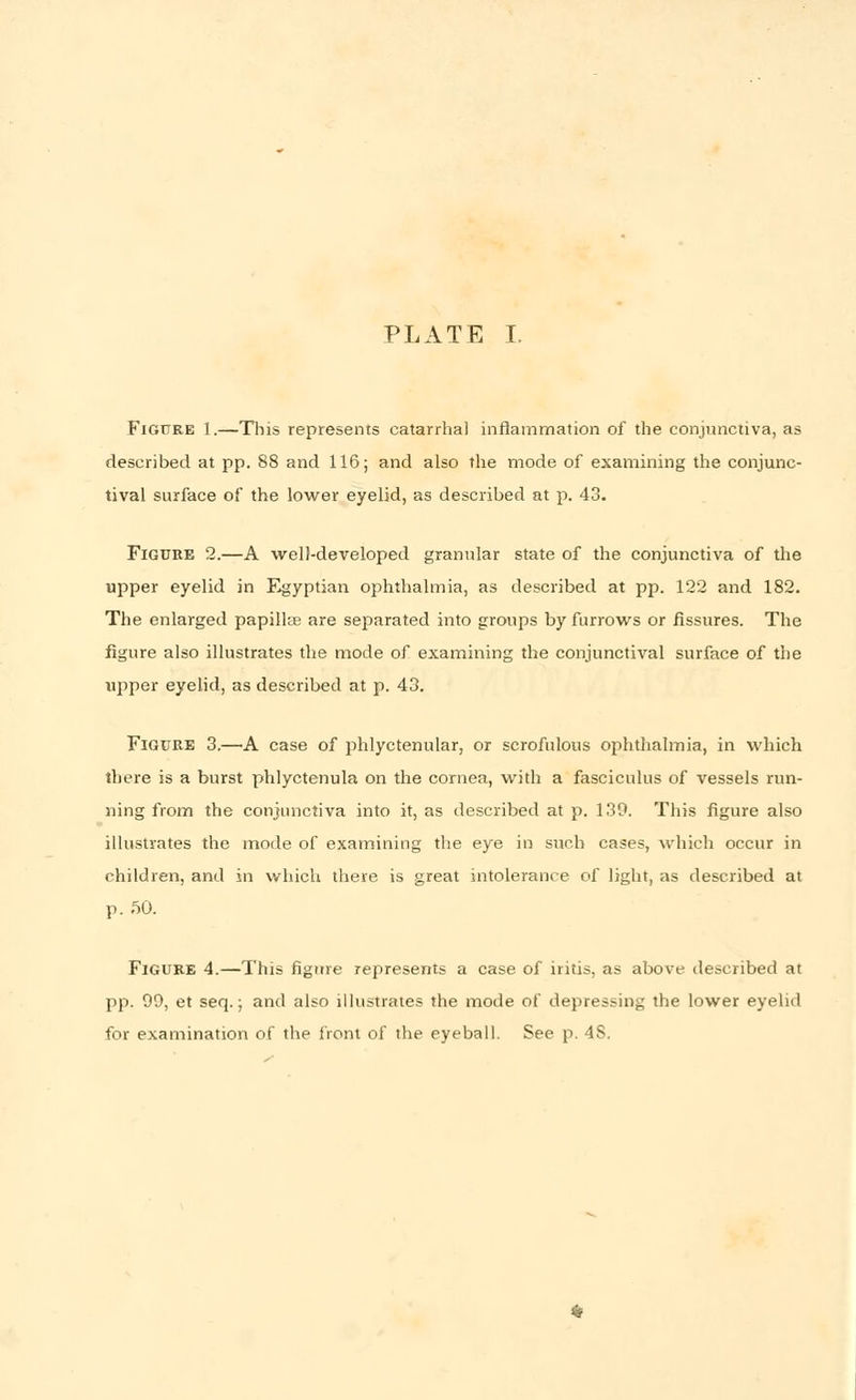 Figure I.—This represents catarrhal inflammation of the conjunctiva, as described at pp. 88 and 116; and also the mode of examining the conjunc- tival surface of the lower eyelid, as described at p. 43. Figure 2.—A well-developed granular state of the conjunctiva of the upper eyelid in Egyptian ophthalmia, as described at pp. 122 and 182. The enlarged papillae are separated into groups by furrows or fissures. The figure also illustrates the mode of examining the conjunctival surface of the upper eyelid, as described at p. 43. Figure 3.—A case of phlyctenular, or scrofulous ophthalmia, in which there is a burst phlyctenula on the cornea, with a fasciculus of vessels run- ning from the conjunctiva into it, as described at p. 139. This figure also illustrates the mode of examining the eye in such cases, which occur in children, and in which there is great intolerance of light, as described at p. 50. Figure 4.—This figure represents a case of iritis, as above described at pp. 99, et seq.; and also illustrates the mode of depressing the lower eyelid for examination of the front of the eyeball. See p. 4S.