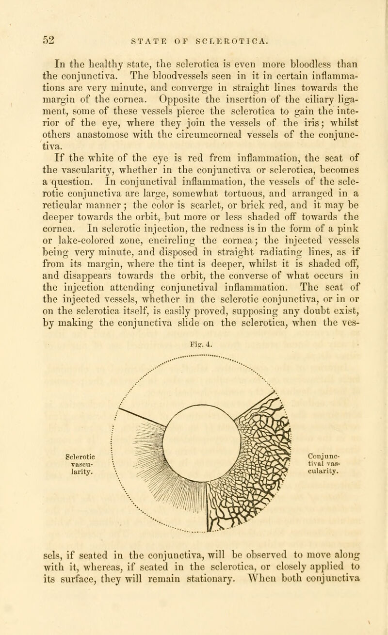 In the healthy state, the sclerotica is even more bloodless than the conjunctiva. The bloodvessels seen in it in certain inflamma- tions are very minute, and converge in straight lines towards the margin of the cornea. Opposite the insertion of the ciliary liga- ment, some of these vessels pierce the sclerotica to gain the inte- rior of the eye, where they join the vessels of the iris; whilst others anastomose with the circumcorneal vessels of the conjunc- tiva. If the white of the eye is red from inflammation, the seat of the vascularity, whether in the conjunctiva or sclerotica, becomes a question. In conjunctival inflammation, the vessels of the scle- rotic conjunctiva are large, somewhat tortuous, and arranged in a reticular manner; the color is scarlet, or brick red, and it may be deeper towards the orbit, but more or less shaded off towards the cornea. In sclerotic injection, the redness is in the form of a pink or lake-colored zone, encircling the cornea; the injected vessels being very minute, and disposed in straight radiating lines, as if from its margin, where the tint is deeper, whilst it is shaded off, and disappears towards the orbit, the converse of what occurs in the injection attending conjunctival inflammation. The seat of the injected vessels, whether in the sclerotic conjunctiva, or in or on the sclerotica itself, is easily proved, supposing any doubt exist, by making the conjunctiva slide on the sclerotica, when the ves- Fi<r. 4. Sclerotic • \ -Jli-ajKlSuflV* Conjunc- vascu- '. '^^^Slb*. j&§5a5595«0^ tival vas- larity. ' - V ,<M^5?^ cularity. sels, if seated in the conjunctiva, will be observed to move along with it, whereas, if seated in the sclerotica, or closely applied to its surface, they will remain stationary. When both conjunctiva