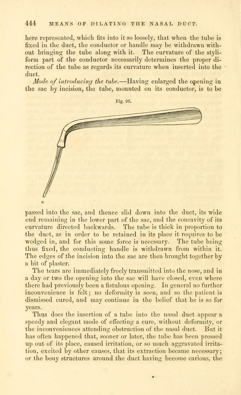here represented, which fits into it so loosely, that when the tube is fixed in the duct, the conductor or handle may be withdrawn with- out bringing the tube along with it. The curvature of the styli- form part of the conductor necessarily determines the proper di- rection of the tube as regards its curvature when inserted into the duct. Mode of introducing the tube.—Having enlarged the opening in the sac by incision, the tube, mounted on its conductor, is to be Fig. 96. passed into the sac, and thence slid down into the duct, its wide end remaining in the lower part of the sac, and the concavity of its curvature directed backwards. The tube is thick in proportion to the duct, as in order to be retained in its place it requires to be wedged in, and for this some force is necessary. The tube being thus fixed, the conducting handle is withdrawn from within it. The edges of the incision into the sac are then brought together by a bit of plaster. The tears are immediately freely transmitted into the nose, and in a day or two the opening into the sac will have closed, even where there had previously been a fistulous opening. In general no further inconvenience is felt; no deformity is seen, and so the patient is dismissed cured, and may continue in the belief that he is so for years. Thus does the insertion of a tube into the nasal duct appear a speedy and elegant mode of effecting a cure, without deformity, or the inconveniences attending obstruction of the nasal duct. But it has often happened that, sooner or later, the tube has been pressed up out of its place, caused irritation, or so much aggravated irrita- tion, excited by other causes, that its extraction became necessary; or the bony structures around the duct having become carious, the
