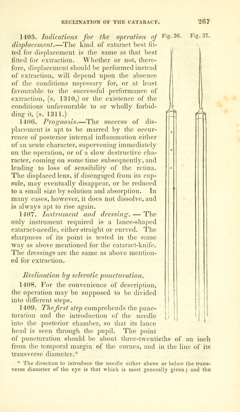 Fig. 36. Fig. 37. I 4 1405. Indications for the operation of displacement.—The kind of cataract best fit- ted for displacement is the same as that best fitted for extraction. Whether or not, there- fore, displacement should be performed instead of extraction, will depend upon the absence of the conditions necessary for, or at least favourable to the successful performance of extraction, (s. 1310,) or the existence of the conditions unfavourable to or wholly forbid- ding it, (s. 1311.) 1406. Prognosis.—The success of dis- placement is apt to be marred by the occur- rence of posterior internal inflammation either of an acute character, supervening immediately on the operation, or of a slow destructive cha- racter, coming on some time subsequently, and leading to loss of sensibility of the retina. The displaced lens, if disengaged from its cap- sule, may eventually disappear, or be reduced to a small size by solution and absorption. In many cases, however, it does not dissolve, and is always apt to rise again. 1407. Instrument and dressing. — The only instrument required is a lance-shaped cataract-needle, either straight or curved. The sharpness of its point is tested in the same way as above mentioned for the cataract-knife. The dressings are the same as above mention- ed for extraction. Reclination by sclerotic puncturation. 1408. For the convenience of description, the operation may be supposed to be divided into different steps. 1409. The first step comprehends the punc- turation and the introduction of the needle into the posterior chamber, so that its lance head is seen through the pupil. The point of puncturation should be about three-twentieths of an inch from the temporal margin of the cornea, and in the line of its transverse diameter.* * The direction to introduce the needle either above or below the trans- verse diameter of the eye is that which is most generally given ; and the