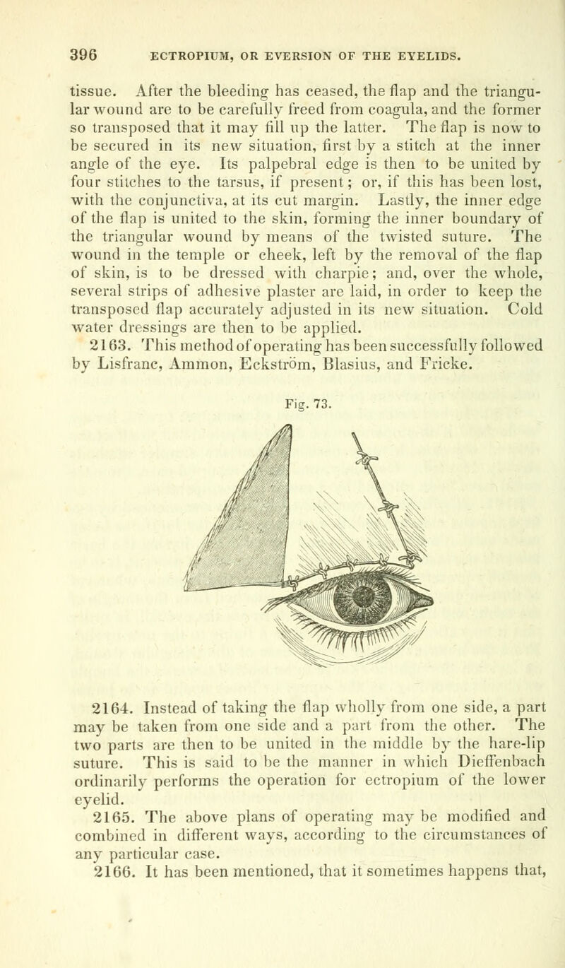 tissue. After the bleeding has ceased, the flap and the triangu- lar wound are to be carefully freed from coagula, and the former so transposed that it may fill up the latter. The flap is now to be secured in its new situation, first by a stitch at the inner angle of the eye. Its palpebral edge is then to be united by four stitches to the tarsus, if present; or, if this has been lost, with the conjunctiva, at its cut margin. Lastly, the inner edge of the flap is united to the skin, forming the inner boundary of the triangular wound by means of the twisted suture. The wound in the temple or cheek, left by the removal of the flap of skin, is to be dressed with charpie; and, over the whole, several strips of adhesive plaster are laid, in order to keep the transposed flap accurately adjusted in its new situation. Cold water dressings are then to be applied. 2163. This method of operating has been successfully followed by Lisfranc, Amnion, Eckstrom, Blasius, and Fricke. Fig. 73. 2164. Instead of taking the flap wholly from one side, a part may be taken from one side and a part from the other. The two parts are then to be united in the middle by the hare-lip suture. This is said to be the manner in which Dieffenbach ordinarily performs the operation for ectropium of the lower eyelid. 2165. The above plans of operating may be modified and combined in different ways, according to the circumstances of any particular case. 2166. It has been mentioned, that it sometimes happens that,