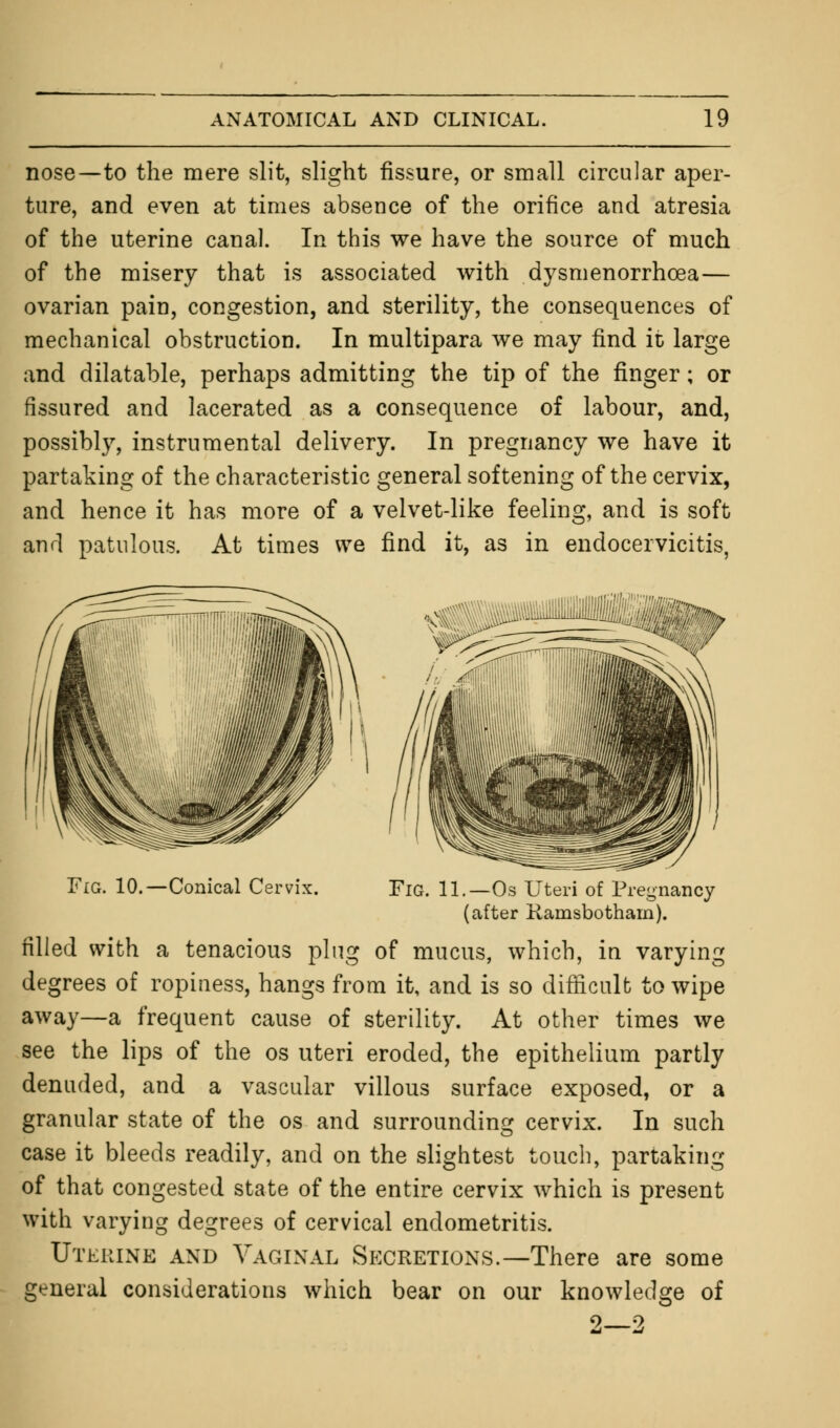 nose—to the mere slit, slight fissure, or small circular aper- ture, and even at times absence of the orifice and atresia of the uterine canal. In this we have the source of much of the misery that is associated with dysmenorrhcea— ovarian pain, congestion, and sterility, the consequences of mechanical obstruction. In multipara we may find it large and dilatable, perhaps admitting the tip of the finger; or fissured and lacerated as a consequence of labour, and, possibly, instrumental delivery. In pregnancy we have it partaking of the characteristic general softening of the cervix, and hence it has more of a velvet-like feeling, and is soft and patulous. At times we find it, as in endocervicitis, Fig. 10.—Conical Cervix. Fig. 11.— Os Uteri of Pregnancy (after Ramsbotham). filled with a tenacious plug of mucus, which, in varying degrees of ropiness, hangs from it, and is so difficult to wipe away—a frequent cause of sterility. At other times we see the lips of the os uteri eroded, the epithelium partly denuded, and a vascular villous surface exposed, or a granular state of the os and surrounding cervix. In such case it bleeds readily, and on the slightest touch, partaking of that congested state of the entire cervix which is present with varying degrees of cervical endometritis. Uterine and Vaginal Secretions.—There are some general considerations which bear on our knowledge of 2—2